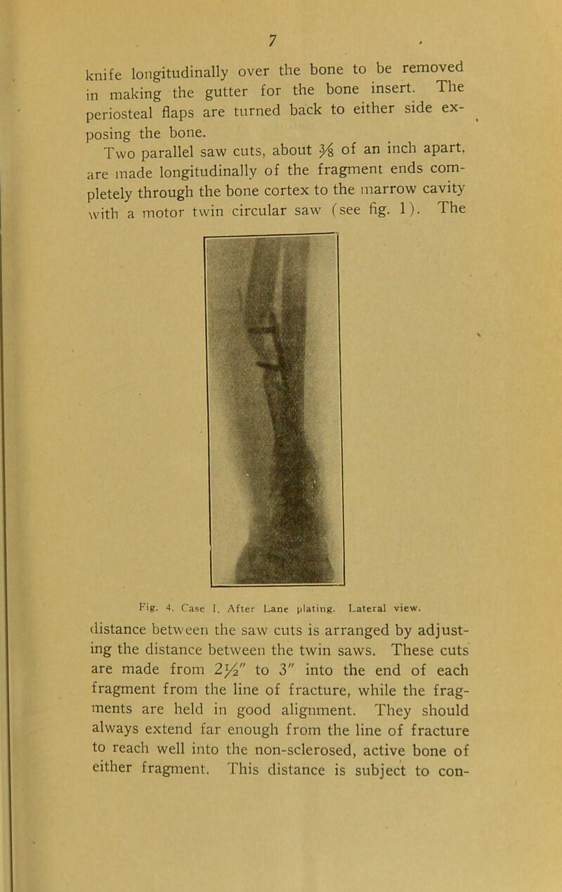 knife longitudinally over the bone to be removed in making the gutter for the bone insert. The periosteal flaps are turned back to either side ex- posing the bone. Two parallel saw cuts, about of an inch apart, are made longitudinally of the fragment ends com- pletely through the bone cortex to the marrow cavity with a motor twin circular saw (see fig. 1). The Fig. 4. Case I. After Lane plating. Lateral view. distance between the saw cuts is arranged by adjust- ing the distance between the twin saws. These cuts are made from 21/2 to 3 into the end of each fragment from the line of fracture, while the frag- ments are held in good alignment. They should always extend far enough from the line of fracture to reach well into the non-sclerosed, active bone of either fragment. This distance is subject to con-