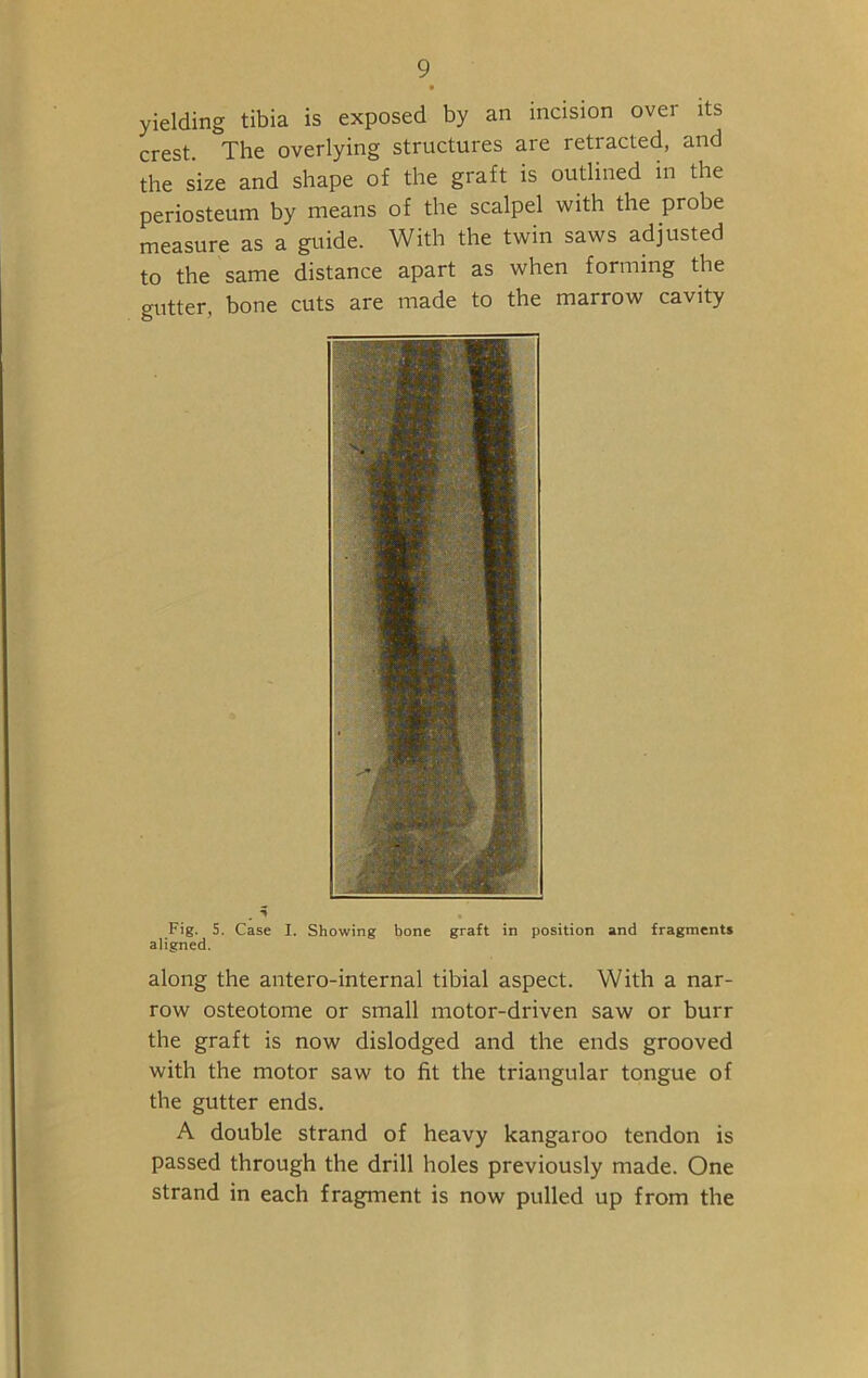 yielding tibia is exposed by an incision over its crest. The overlying structures are retracted, and the size and shape of the graft is outlined in the periosteum by means of the scalpel with the probe measure as a guide. With the twin saws adjusted to the same distance apart as when forming the gutter, bone cuts are made to the marrow cavity Fig. 5. Case I. Showing bone graft in position and fragments aligned. along the antero-internal tibial aspect. With a nar- row osteotome or small motor-driven saw or burr the graft is now dislodged and the ends grooved with the motor saw to fit the triangular tongue of the gutter ends. A double strand of heavy kangaroo tendon is passed through the drill holes previously made. One strand in each fragment is now pulled up from the