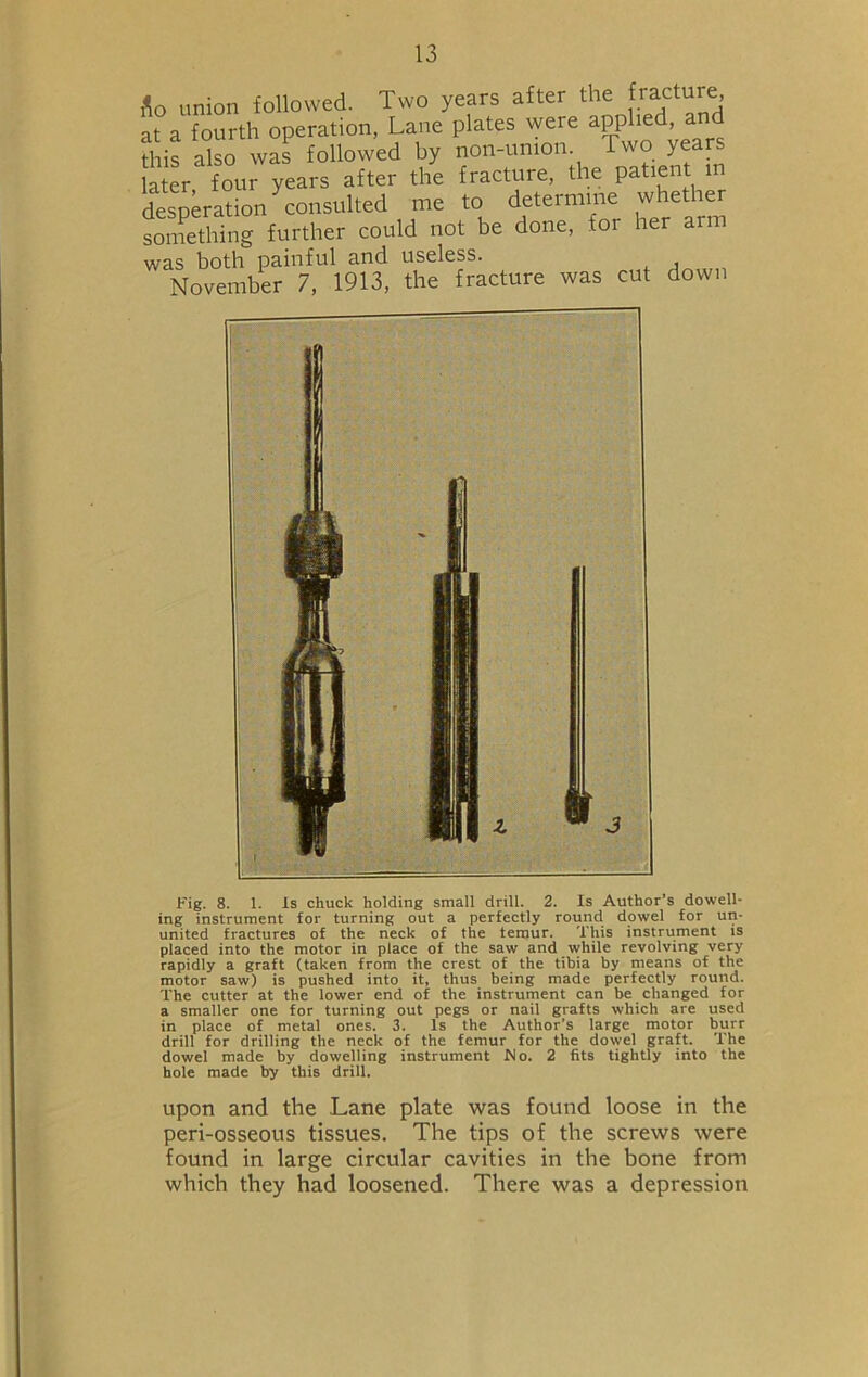 flo union followed. Two years after the fracture, at a fourth operation, Lane plates were applied a this also was followed by non-union Two years h er four years after the fracture, the patient m desperation Consulted me to determine whether something further could not be done, for her arm was both painful and useless. November 7, 1913, the fracture was cut down Fig. 8. 1. Is chuck holding small drill. 2. Is Author’s dowell- ing instrument for turning out a perfectly round dowel for un- united fractures of the neck of the temur. This instrument is placed into the motor in place of the saw and while revolving very rapidly a graft (taken from the crest of the tibia by means of the motor saw) is pushed into it, thus being made perfectly round. The cutter at the lower end of the instrument can be changed for a smaller one for turning out pegs or nail grafts which are used in place of metal ones. 3. Is the Author’s large motor burr drill for drilling the neck of the femur for the dowel graft. The dowel made by dowelling instrument No. 2 fits tightly into the hole made by this drill. upon and the Lane plate was found loose in the peri-osseous tissues. The tips of the screws were found in large circular cavities in the bone from which they had loosened. There was a depression