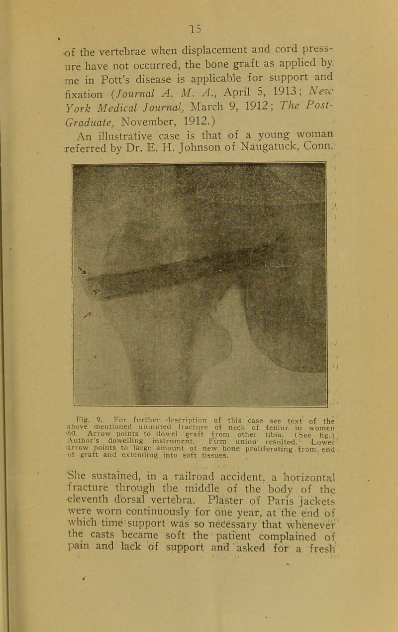 of the vertebrae when displacement and cord press- ure have not occurred, the bone graft as applied by. me in Pott’s disease is applicable for support and fixation (Journal A. M. A., April 5, 1913; New York Medical Journal, March 9, 1912; The Post- Graduate, November, 1912.) An illustrative case is that of a young woman referred by Dr. K. H. Johnson of Naugatuck, Conn. Fig. 9. For further description of this case see text of the above mentioned ununited fracture of neck of femur in women -60. Arrow points to dowel graft from other tibia. (See tig,) Author’s do welling instrument. Firm union resulted. Lower arrow points to large amount ot new bone proliferating , from, end of graft and extending into soft tissues. She sustained, in a railroad accident, a horizontal fracture through the middle of the body of the •eleventh dbrsal vertebra. Plaster of Paris jackets were worn continuously for one year, at the end of which time support was so nedessary that whenever' the casts became soft the patient complained of pain and lack of support and ' asked for a fresh