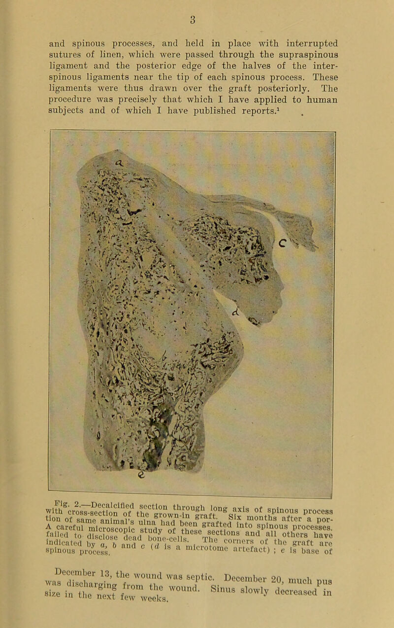 and spinous processes, and held in place with interrupted sutures of linen, which were passed through the supraspinous ligament and the posterior edge of the halves of the inter- spinous ligaments near the tip of each spinous process. These ligaments were thus drawn over the graft posteriorly. The procedure was precisely that which I have applied to human subjects and of which I have published reports.1 .. a  v, C'H H- D'“'” spinous pr ocess. a ° (d iS a mlcrotome artefact) ; e is base of WOUt'!d Sq’UC' D'ce,,,b“ 20- ■“* P“8 - SiS ^ /ln