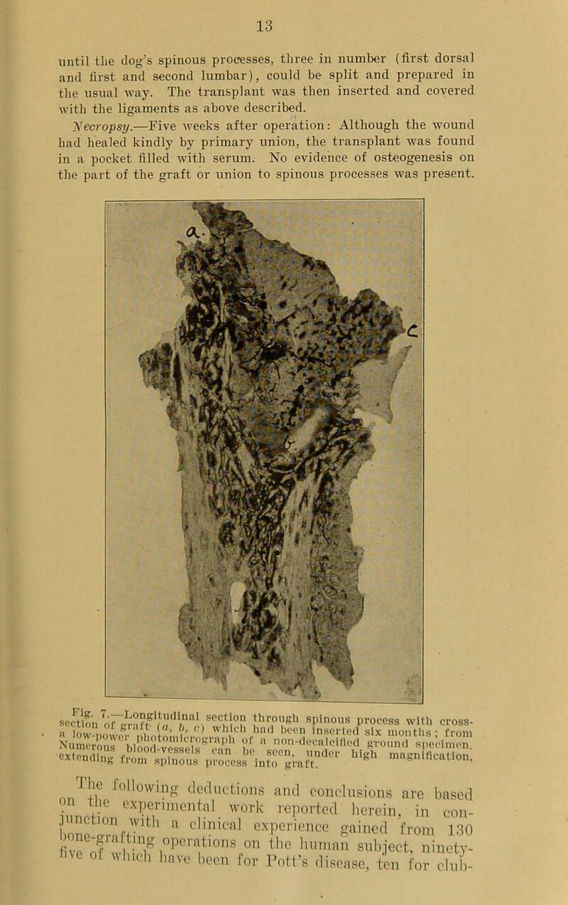 until the clog’s spinous processes, three in number (first dorsal and first and second lumbar), could be split and prepared in the usual way. The transplant was then inserted and covered with the ligaments as above described. Necropsy.—Five weeks after operation: Although the wound had healed kindly by primary union, the transplant was found in a pocket filled with serum. No evidence of osteogenesis on the part of the graft or union to spinous processes was present. p™*** «pi»om koto,, »!» «•<,>!. ;s^re,,r' 'el1 I'lre following deductions and conclusions are based H3 experimental work reported herein, in con- a dinical exPerience gained from 130 five nf l ig,°Perf!tl0ns °n the lmman subject, ninety- hve ot hich have been for Pott’s disease, ten for club-