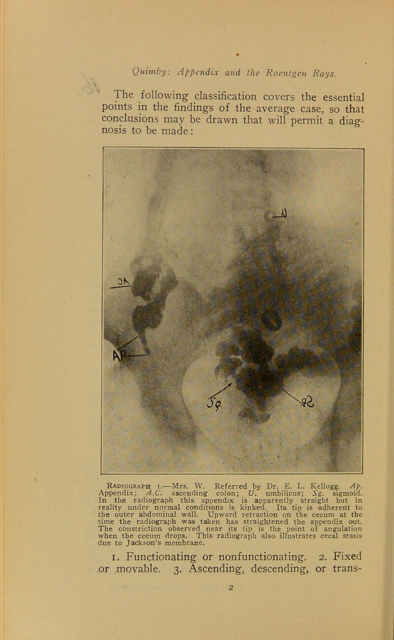 The following classification covers the essential points in the findings of the average case, so that conclusions may be drawn that will permit a diag- nosis to be made: Radiograph i.—Mrs. W. Referred by Dr. E. L. Kellogg. Ap. Appendix; A.C. ascending colon; U. umbilicus; Sg. sigmoid. In the radiograph this appendix is apparently straight but in reality under normal conditions is kinked. Its tip is adherent to the outer abdominal wall. Upward retraction on the cecum at the time the radiograph was taken has straightened the appendix out. The constriction observed near its tip is the point of angulation when the cecum drops. This radiograph also illustrates cecal stasis due to Jackson’s membrane. I. Functionating or nonfunctionating. 2. Fixed or movable. 3. Ascending, descending, or trans-