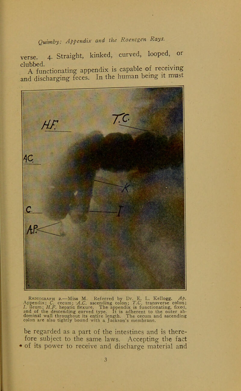 verse. 4. Straight, kinked, curved, looped, or clubbed. . , r A functionating appendix is capable of receiving and discharging feces. In the human being it must Radiograph 2.—Miss M. Referred by Dr. E. L. Kellogg. Ap. Appendix; C. cecum; A.C. ascending colon; T.C. transverse colon; 1. ileum; H.F. hepatic flexure. The appendix is functionating, fixed, and of the descending curved type. It is adherent to the outer ab- dominal wall throughout its entire length. The cecum and ascending colon are also tightly bound with a Jackson’s membrane. be regarded as a part of the intestines and is there- fore subject to the same laws. Accepting the fact • of its power to receive and discharge material and