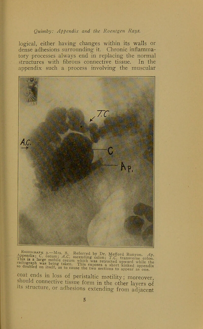 logical, either having changes within its walls or dense adhesions surrounding it. Chronic inflamma- tory processes always end in replacing the normal structures with fibrous connective tissue. In the appendix such a process involving the muscular Ap'nendix^C1 Refer'?d ,Dr- Mefford Runyon. Ap. This l / A'C- asce,nd!ng colon; T.C. transverse colon, radiograph wfs Ting taken rSj=hPWas rctract,ed upward while the so doubled on itself as to cans! the rXP°SeS ? sh°rt 1;inkc,i aPPcndix useu, as to cause the two sections to appear as one. coat ends in loss of peristaltic motility; moreover should connective tissue form in the other layers of its structure, or adhesions extending from adjacent