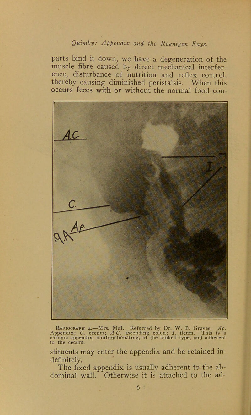 parts bind it down, we have a degeneration of the muscle fibre caused by direct mechanical interfer- ence, disturbance of nutrition and reflex control, thereby causing diminished peristalsis. When this occurs feces with or without the normal food con- Radiograph 4.—Mrs. Mcl. Referred by Dr. W. B. Graves. Ap. Appendix; C. cecum; A.C. ascending colon; I. ileum. This is a chronic appendix, nonfunctionating, of the kinked type, and adherent to the cecum. stituents may enter the appendix and be retained in- definitely. The fixed appendix is usually adherent to the ab- dominal wall. Otherwise it is attached to the ad-