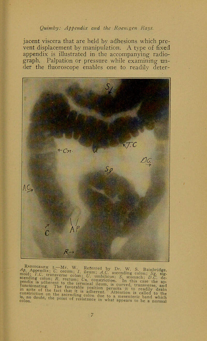 jacent viscera that are held by adhesions which pre- vent displacement by manipulation. A type of fixed appendix is illustrated in the accompanying radio- graph. Palpation or pressure while examining un- der the fluoroscope enables one to readily deter- AP- Appetidix; C cecum^'/ deum^d C* Dr' pV' S‘, Baibrid8c- pendix is adherent to the^'err ?°?}stnct,9T1- I this case the ap- func(donating. The favorable 'nolifin1”’ 1S ?urv.ed- transverse, and constriction t ^ ^ U, no doubt, the point of resistance inVhat* appTa?^be^nSK