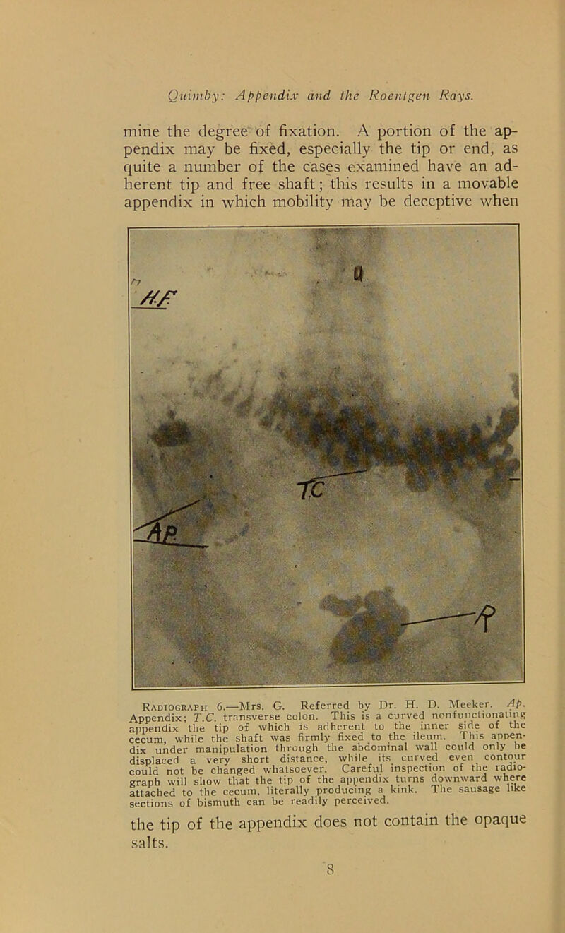 mine the degree of fixation. A portion of the ap- pendix may be fixed, especially the tip or end, as quite a number of the cases examined have an ad- herent tip and free shaft; this results in a movable appendix in which mobility may be deceptive when Radiograph 6.—Mrs. G. Referred by Dr. H. D. Meeker. Ap. Appendix; T.C. transverse colon. This is a curved nonfunctionating appendix the tip of which is adherent to the inner side of the cecum, while the shaft was firmly fixed to the ileum. This appen- dix under manipulation through the abdominal wall could only be displaced a very short distance, while its curved even contour could not be changed whatsoever. Careful inspection of the radio- graph will show that the tip of the appendix turns downward where attached to the cecum, literally producing a kink. The sausage like sections of bismuth can be readily perceived. the tip of the appendix does not contain the opaque salts.