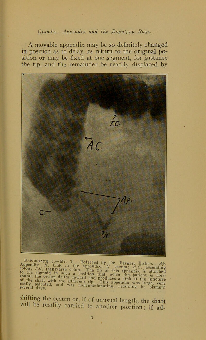 A movable appendix may be so definitely changed in position as to delay its return to the original po- sition or may be fixed at one segment, for instance the tip, and the remainder be readily displaced by Appendix™ A1 7ld^kIri'n T,'l Refcrre!’ b>' Dr- Earnest Bishop. Ap. rJlnn /i ■ „ink ln Vle aPP,endix; C. cecum; A.C. ascending irsAif *°/^ V,usrf several days* “ nonfunctionating, retaining its bismuth Shifting the cecum or, if of unusual length, the shaft will be readily earned to another position; if ad- o