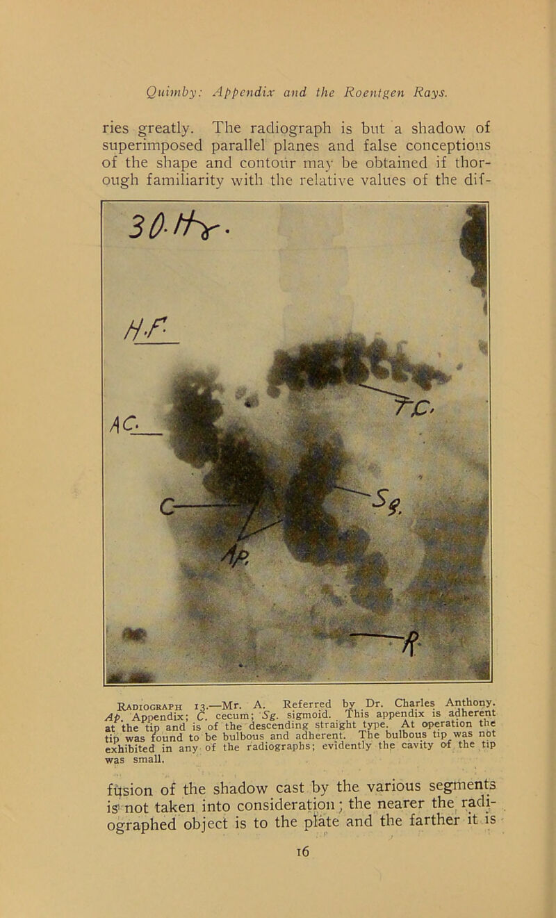 ries greatly. The radiograph is but a shadow of superimposed parallel planes and false conceptions of the shape and contour may be obtained if thor- ough familiarity with the relative values of the dif- Radiograph 13.—Mr. A. Referred by Dr. Charles Anthony. Ap Appendix; C. cecum; Sg. sigmoid. This appendix is adherent at the tip and is of the descending straight type At operation the tip was found to be bulbous and adherent. The bulbous tip was not exhibited in any of the radiographs; evidently the cavity of the tip was small. fusion of the shadow cast by the various segments is' not taken into consideration; the nearer the radi- ographed object is to the plate and the farther it is