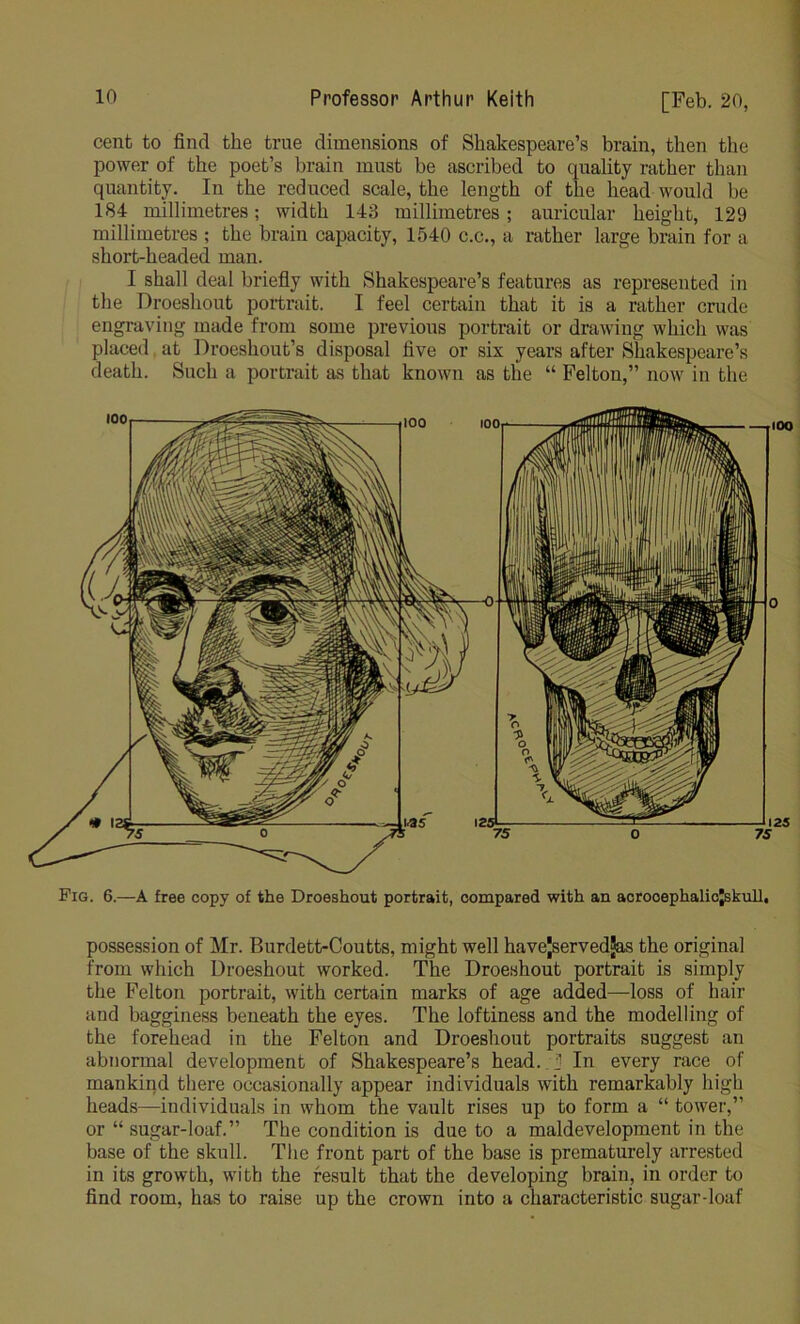 cent to find the true dimensions of Shakespeare’s brain, then the power of the poet’s brain must be ascribed to quality rather than quantity. In the reduced scale, the length of the head would be 184 millimetres; width 143 millimetres ; auricular height, 129 millimetres ; the brain capacity, 1540 c.c., a rather large brain for a short-headed man. I shall deal briefly with Shakespeare’s features as represented in the Droeshout portrait. I feel certain that it is a rather crude engraving made from some previous portrait or drawing which was placed at Droeshout’s disposal five or six years after Shakespeare’s death. Such a portrait as that known as the “ Felton,” now in the Fig. 6.—A free copy of the Droeshout portrait, compared with an acrooephalicjskull. possession of Mr. Burdett-Coutts, might well havejservedjas the original from which Droeshout worked. The Droeshout portrait is simply the Felton portrait, with certain marks of age added—loss of hair and bagginess beneath the eyes. The loftiness and the modelling of the forehead in the Felton and Droeshout portraits suggest an abnormal development of Shakespeare’s head. J In every race of mankind there occasionally appear individuals with remarkably high heads—individuals in whom the vault rises up to form a “ tower,” or “sugar-loaf.” The condition is due to a maldevelopment in the base of the skull. The front part of the base is prematurely arrested in its growth, with the result that the developing brain, in order to find room, has to raise up the crown into a characteristic sugar-loaf