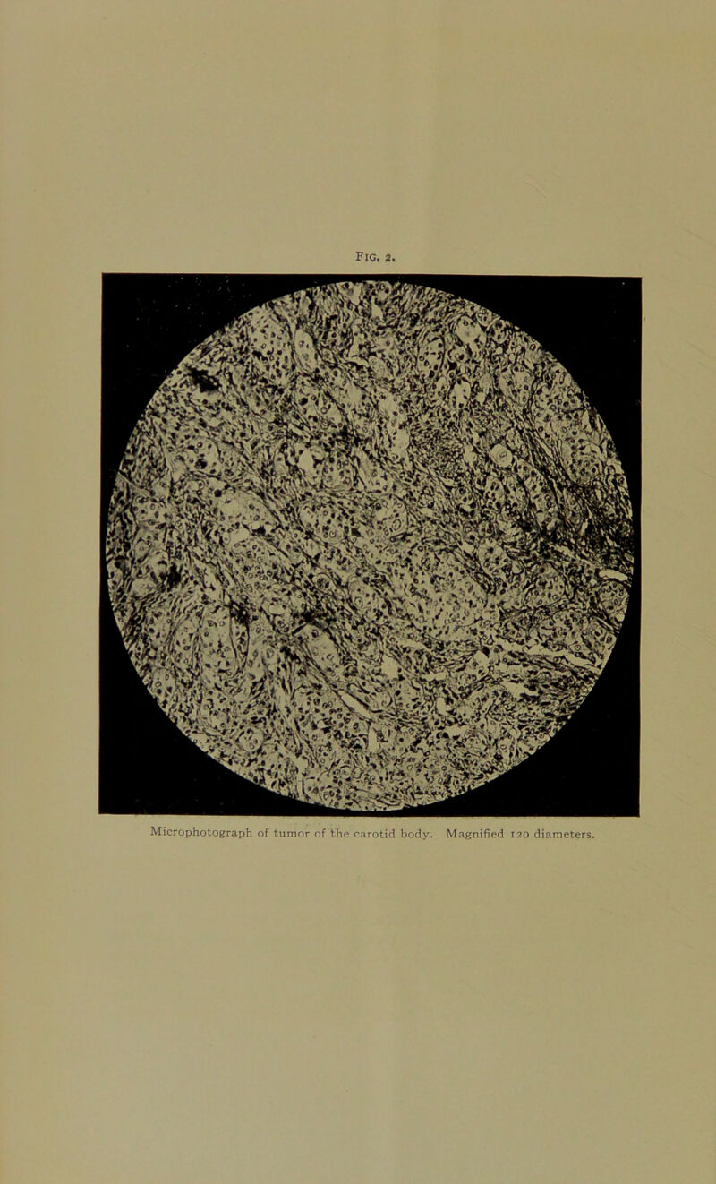 Microphotograph of tumor of the carotid body. Magnified 120 diameters.