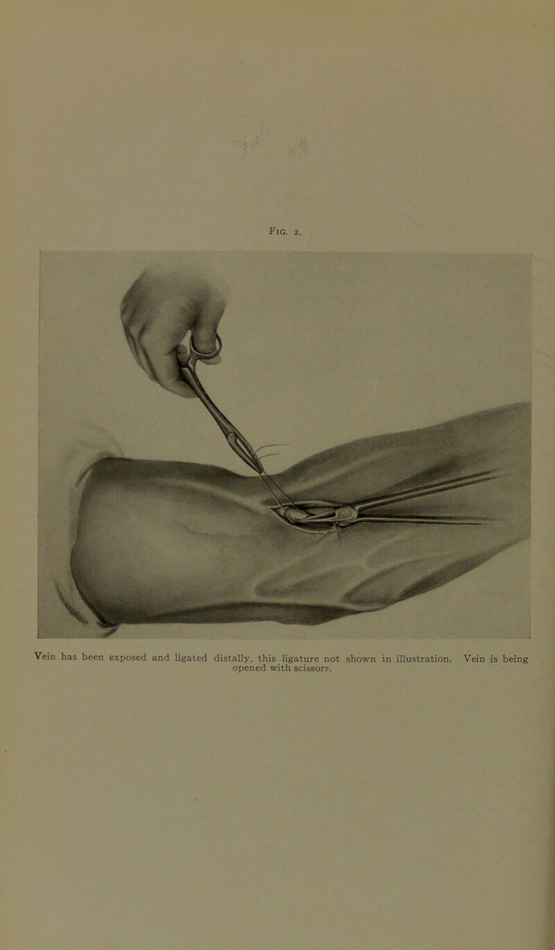 t Vein has been exposed and ligated distally, this ligature not shown in illustration. opened with scissors. Vein is being