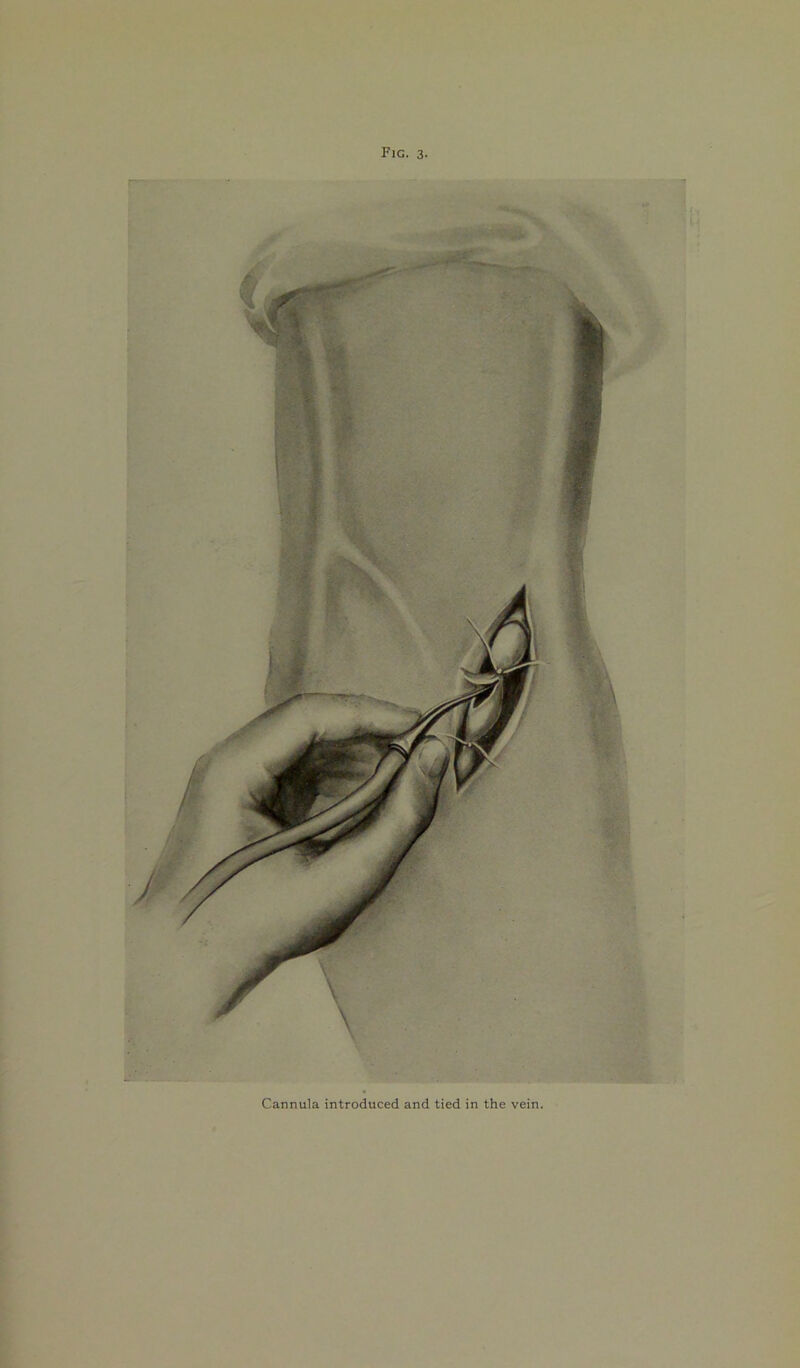 Cannula introduced and tied in the vein.