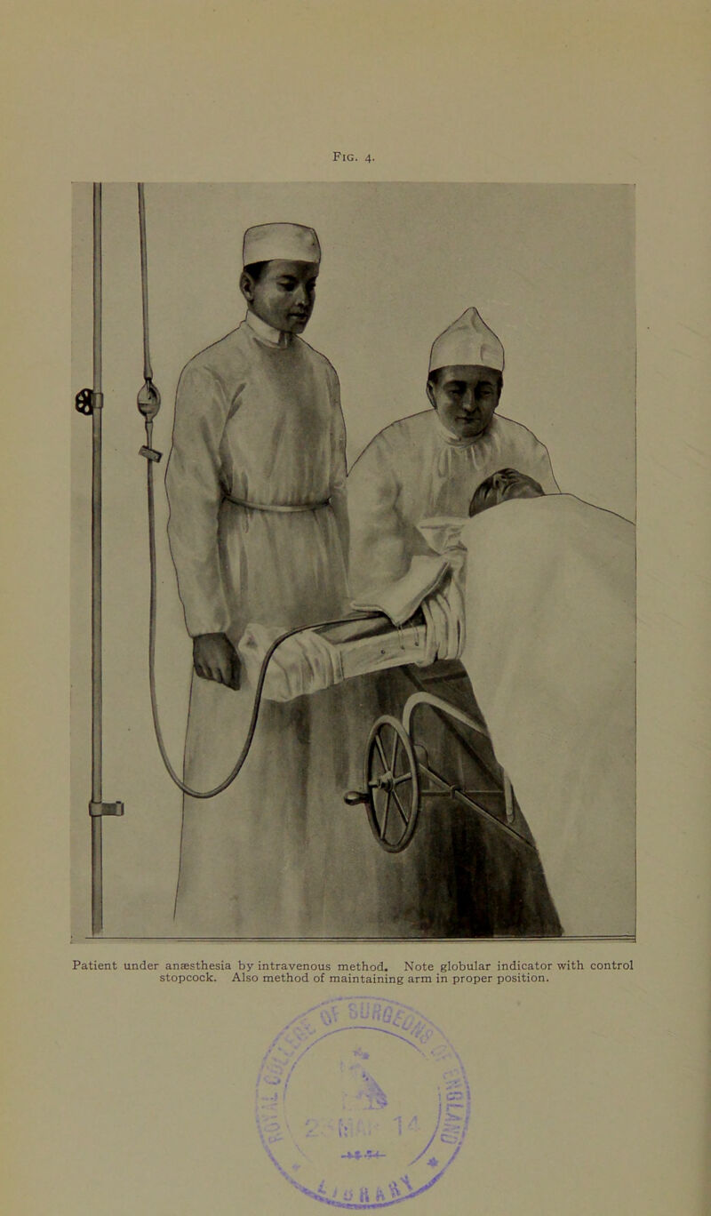 Patient under anaesthesia by intravenous method. Note globular indicator with control stopcock. Also method of maintaining arm in proper position. 47 4 * / ! .1 \