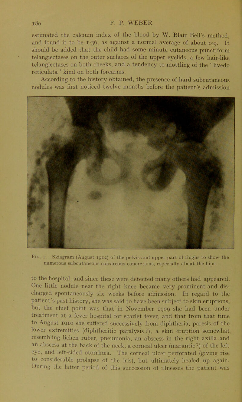 estimated the calcium index of the blood by W. Blair Bell's method, and found it to be 1-36, as against a normal average of about 0-9. It should be added that the child had some minute cutaneous punctiform telangiectases on the outer surfaces of the upper eyelids, a few hair-like telangiectases on both cheeks, and a tendency to mottling of the ‘ livedo reticulata ’ kind on both forearms. According to the history obtained, the presence of hard subcutaneous nodules was first noticed twelve months before the patient’s admission Fig. 1. Skiagram (August 1912) of the pelvis and upper part of thighs to show the numerous subcutaneous calcareous concretions, especially about the hips. to the hospital, and since these were detected many others had appeared. One little nodule near the right knee became very prominent and dis- charged spontaneously six weeks before admission. In regard to the patient’s past history, she was said to have been subject to skin eruptions, but the chief point was that in November 1909 she had been under treatment at a fever hospital for scarlet fever, and that from that time to August 1910 she suffered successively from diphtheria, paresis of the lower extremities (diphtheritic paralysis ?), a skin eruption somewhat resembling lichen ruber, pneumonia, an abscess in the right axilla and an abscess at the back of the neck, a corneal ulcer (marantic?) of the left eye, and left-sided otorrhoea. The corneal ulcer perforated (giving rise to considerable prolapse of the iris), but ultimately healed up again. During the latter period of this succession of illnesses the patient was