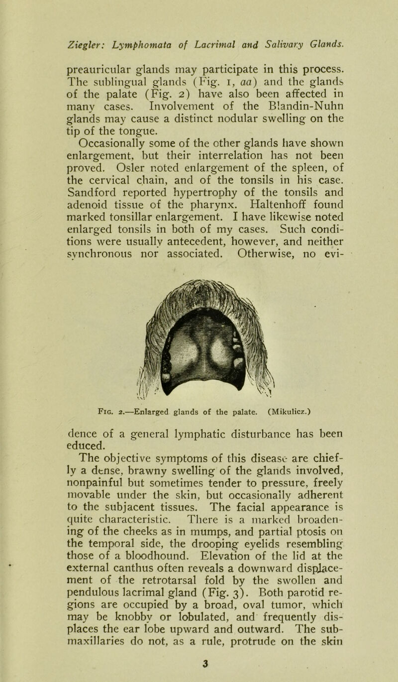 preauricular glands may participate in this process. The sublingual glands (Fig. I, aa) and the glands of the palate (Fig. 2) have also been affected in many cases. Involvement of the Blandin-Nuhn glands may cause a distinct nodular swelling on the tip of the tongue. Occasionally some of the other glands have shown enlargement, but their interrelation has not been proved. Osier noted enlargement of the spleen, of the cervical chain, and of the tonsils in his case. Sandford reported hypertrophy of the tonsils and adenoid tissue of the pharynx. Haltenhoff found marked tonsillar enlargement. I have likewise noted enlarged tonsils in both of my cases. Such condi- tions were usually antecedent, however, and neither synchronous nor associated. Otherwise, no evi- Fig. 2.—Enlarged glands of the palate. (Mikulicz.) dence of a general lymphatic disturbance has been educed. The objective symptoms of this disease are chief- ly a dense, brawny swelling of the glands involved, nonpainful but sometimes tender to pressure, freely movable under the skin, but occasionally adherent to the subjacent tissues. The facial appearance is quite characteristic. There is a marked broaden- ing of the cheeks as in mumps, and partial ptosis on the temporal side, the drooping eyelids resembling those of a bloodhound. Elevation of the lid at the external canthus often reveals a downward displace- ment of the retrotarsal fold by the swollen and pendulous lacrimal gland (Fig. 3). Both parotid re- gions are occupied by a broad, oval tumor, which may be knobby or lobulated, and frequently dis- places the ear lobe upward and outward. The sub- maxillaries do not, as a rule, protrude on the skin