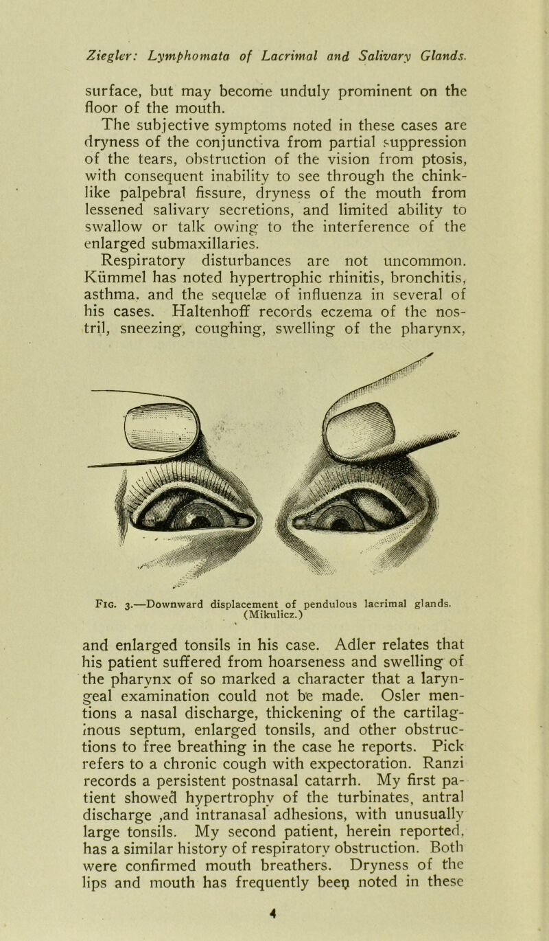 surface, but may become unduly prominent on the floor of the mouth. The subjective symptoms noted in these cases are dryness of the conjunctiva from partial suppression of the tears, obstruction of the vision from ptosis, with consequent inability to see through the chink- like palpebral fissure, dryness of the mouth from lessened salivary secretions, and limited ability to swallow or talk owing to the interference of the enlarged submaxillaries. Respiratory disturbances arc not uncommon. Kiimmel has noted hypertrophic rhinitis, bronchitis, asthma, and the sequelae of influenza in several of his cases. Haltenhoff records eczema of the nos- tril, sneezing, coughing, swelling of the pharynx, Fig. 3.—Downward displacement of pendulous lacrimal glands. (Mikulicz.) and enlarged tonsils in his case. Adler relates that his patient suffered from hoarseness and swelling of the pharynx of so marked a character that a laryn- geal examination could not be made. Osier men- tions a nasal discharge, thickening of the cartilag- inous septum, enlarged tonsils, and other obstruc- tions to free breathing in the case he reports. Pick refers to a chronic cough with expectoration. Ranzi records a persistent postnasal catarrh. My first pa- tient showed hypertrophy of the turbinates, antral discharge ,and intranasal adhesions, with unusually large tonsils. My second patient, herein reported, has a similar history of respiratory obstruction. Both were confirmed mouth breathers. Dryness of the lips and mouth has frequently beep noted in these