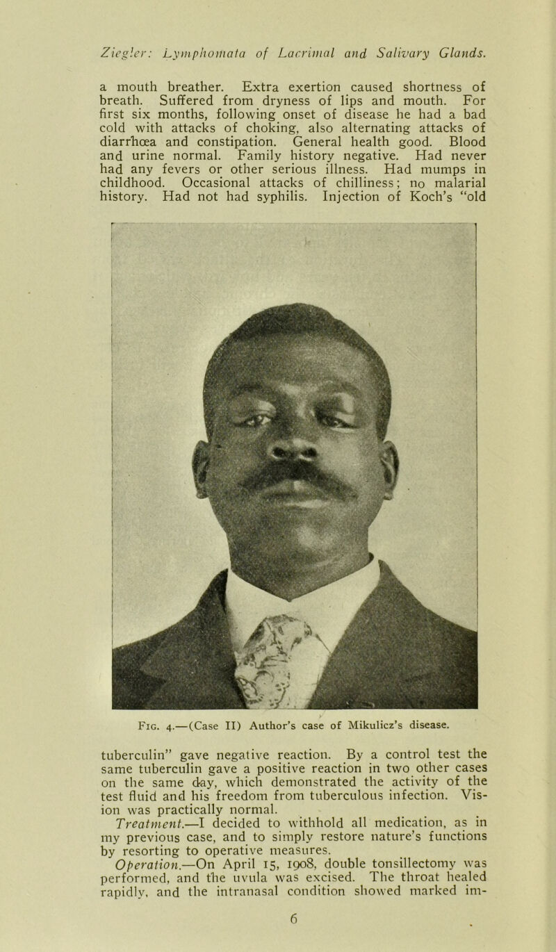 a mouth breather. Extra exertion caused shortness of breath. Suffered from dryness of lips and mouth. For first six months, following onset of disease he had a bad cold with attacks of choking, also alternating attacks of diarrhoea and constipation. General health good. Blood and urine normal. Family history negative. Had never had any fevers or other serious illness. Had mumps in childhood. Occasional attacks of chilliness; no malarial history. Had not had syphilis. Injection of Koch’s “old r ' i Fig. 4.—(Case II) Author’s case of Mikulicz’s disease. tuberculin” gave negative reaction. By a control test the same tuberculin gave a positive reaction in two other cases on the same day, which demonstrated the activity of the test fluid and his freedom from tuberculous infection. Vis- ion was practically normal. Treatment.—I decided to withhold all medication, as in my previous case, and to simply restore nature’s functions by resorting to operative measures. Operation.—On April 15, 1908, double tonsillectomy was performed, and the uvula was excised. The throat healed rapidly, and the intranasal condition showed marked im-