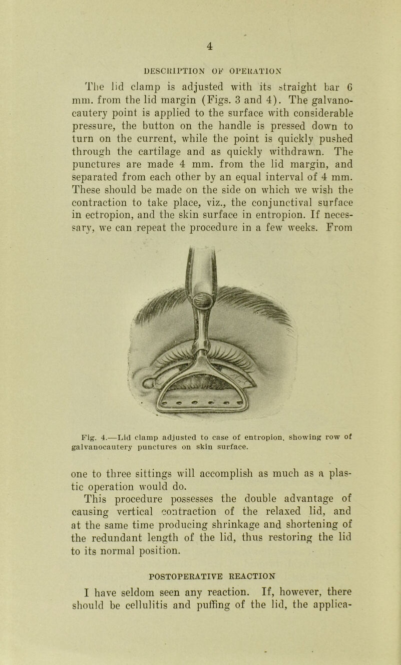 DESCKIPTION OF OPEHATION Tlie lid cJamp is adjusted with its straight bar G mill, from the lid margin (Figs. 3 and 4). The galvano- cautery point is applied to the surface with considerable pressure, the button on the handle is pressed down to turn on the current, while the point is quickly pushed through the cartilage and as quickly withdrawn. The punctures are made 4 mm. from the lid margin, and separated from each other by an equal interval of 4 mm. These should be made on the side on which we wish the contraction to take place, viz., the conjunctival surface in ectropion, and the skin surface in entropion. If neces- sary, w^e can repeat the procedure in a few weeks. From Fig. 4.—Lid clamp adjusted to case of entropion, showing row of galvanocautery punctures on skin surface. one to three sittings will accomplish as much as a plas- tic operation would do. This procedure possesses the double advantage of causing vertical contraction of the relaxed lid, and at the same time producing shrinkage and shortening of the redundant length of the lid, thus restoring the lid to its normal position. POSTOPERATIVE REACTION I have seldom seen any reaction. If, however, there should be cellulitis and puffing of the lid, the applica-