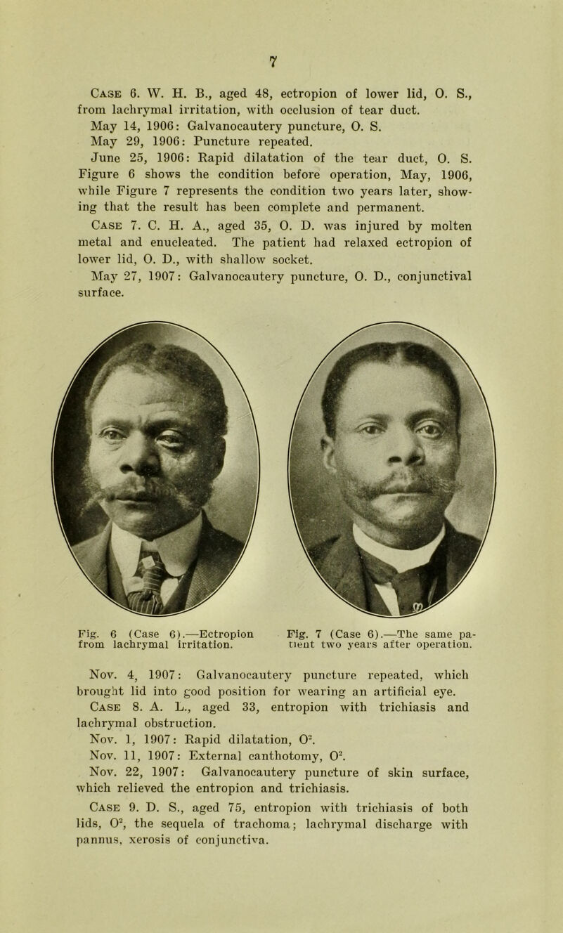 Case 6. W. H. B., aged 48, ectropion of lower lid, 0. S., from lachrymal irritation, with occlusion of tear duct. May 14, 1906: Galvanocautery puncture, O. S. May 29, 1906: Puncture repeated. June 25, 1906: Rapid dilatation of the tear duct, 0. S. Figure 6 shows the condition before operation, May, 1906, while Figure 7 represents the condition two years later, show- ing that the result has been complete and permanent. Case 7. C. H. A., aged 35, 0. D. was injured by molten metal and enucleated. The patient had relaxed ectropion of lower lid, 0. D., with shallow socket. May 27, 1907: Galvanocautery puncture, 0. D., conjunctival surface. Fig. 6 (Case 6).—Ectropion Fig. 7 (Case 6).—The same pa- from lachrymal irritation. neut two years after operation. Nov. 4, 1907: Galvanocautery puncture repeated, which brought lid into good position for wearing an artificial eye. Case 8. A. L., aged 33, entropion with trichiasis and lachrymal obstruction. Nov. 1, 1907: Rapid dilatation. O'. Nov. 11, 1907: External canthotomy, 0*. Nov. 22, 1907: Galvanocautery puncture of skin surface, which relieved the entropion and trichiasis. Case 9. D. S., aged 75, entropion with trichiasis of both lids, O', the sequela of trachoma; lachrymal discharge with pannus, xerosis of conjunctiva.