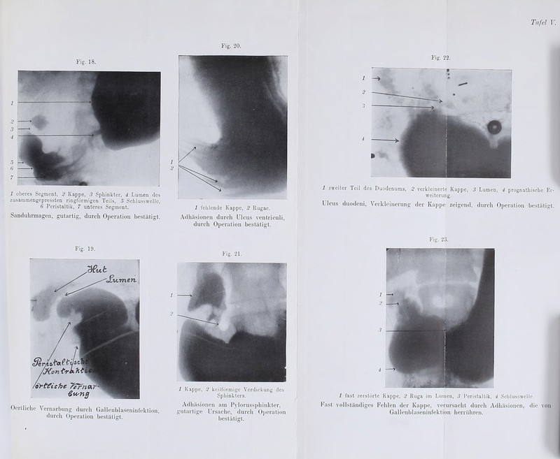 1 oberes Segment, 2 Kappe, 3 Sphinkter, 4 Lumen des zusammengepressten ringförmigen Teils, 5 Scblusswellc, 6 Peristaltik, 7 unteres Segment. Sanduhrmagen, gutartig, durch Operation bestätigt. 1 fehlende Kappe, 2 Rugae. Adhäsionen durch Ulcus ventriculi, durch Operation bestätigt. Fig. 19. Oertliche Vernarbung durch Gallenblaseninfektion, durch Operation bestätigt. Fig. 21. 1 1 Kappe, 2 keilförmige Verdickung des Sphinkters. Adhäsionen am Pylorussphinkler, gutartige Ursache, durch Operation bestätigt. Tafel V. 1 2 1 zweiter Teil des Duodenums, 2 verkleinerte Kappe, 3 Lumen, 4 prognathischc Er- weiterung. Ulcus duodeni, Verkleinerung der Kappe zeigend, durch Operation bestätigt. 1 2 3 4 Fig- 23. Fig. 22. 1 fast zerstörte Kappe, 2 Ruga im Lumen, 3 Peristaltik, 4 Schlusswelle. Fast vollständiges Fehlen der Kappe, verursacht durch Adhäsionen, die von Gallenblaseninfektion herrühren.