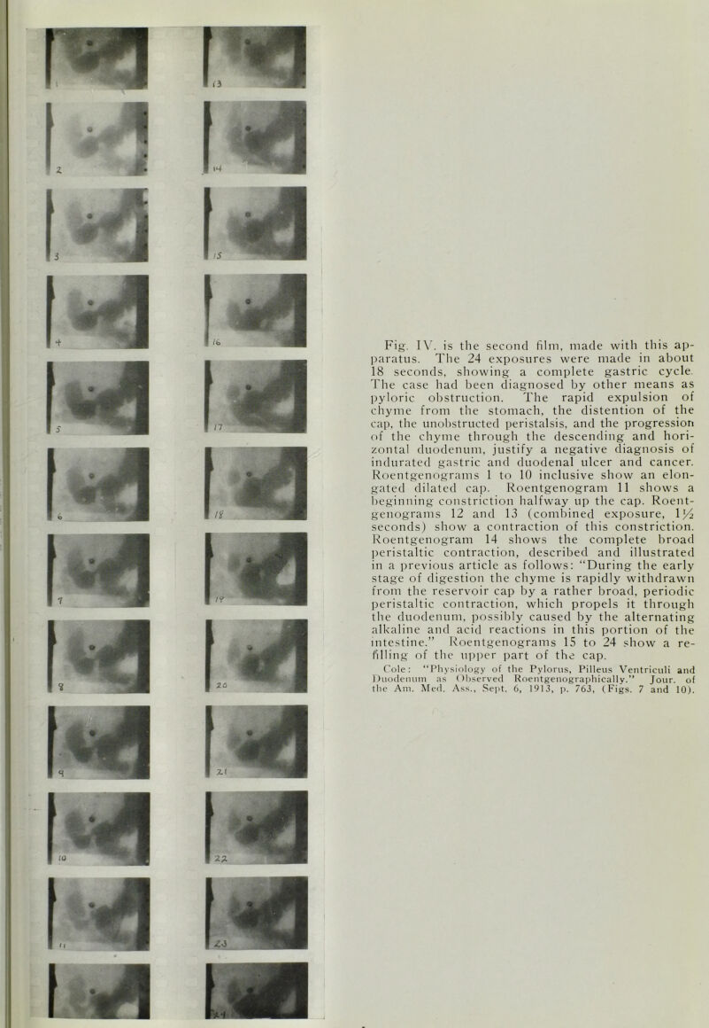 Fig. IV. is the second film, made with this ap- paratus. The 24 exposures were made in about 18 seconds, showing a complete gastric cycle. The case had been diagnosed by other means as pyloric obstruction. The rapid expulsion of chyme from the stomach, the distention of the cap, the unobstructed peristalsis, and the progression of the chyme through the descending and hori- zontal duodenum, justify a negative diagnosis of indurated gastric and duodenal ulcer and cancer. Roentgenograms 1 to 10 inclusive show an elon- gated dilated cap. Roentgenogram 11 shows a beginning constriction halfway up the cap. Roent- genograms 12 and 13 (combined exposure, IR2 seconds) show a contraction of this constriction. Roentgenogram 14 shows the complete broad peristaltic contraction, described and illustrated in a previous article as follows: “During the early stage of digestion the chyme is rapidly withdrawn from the reservoir cap by a rather broad, periodic peristaltic contraction, which propels it through the duodenum, possibly caused by the alternating- alkaline and acid reactions in this portion of the intestine.” Roentgenograms 15 to 24 show a re- filling of the upper part of the cap. Cole: “Physiology of the Pylorus, Pilleus Ventriculi and Duodenum as Observed Roentgeuographically.” Jour, of the Am. Med. Ass., Sept. 6, 1913, p. 763, (Figs. 7 and 10).