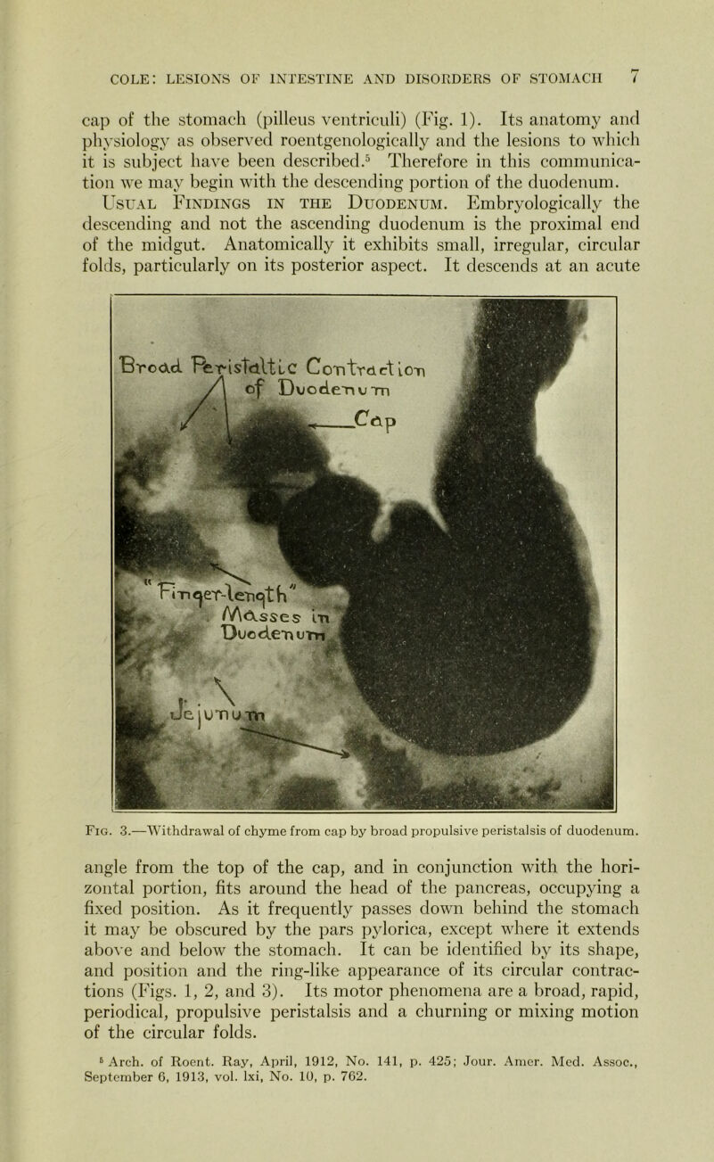 cap of the stomach (pilleus ventriculi) (Fig. 1). Its anatomy and physiology as observed roentgenologically and the lesions to which it is subject have been described.5 Therefore in this communica- tion we may begin with the descending portion of the duodenum. Usual Findings in the Duodenum. Embryologically the descending and not the ascending duodenum is the proximal end of the midgut. Anatomically it exhibits small, irregular, circular folds, particularly on its posterior aspect. It descends at an acute Fig. 3.—Withdrawal of chyme from cap by broad propulsive peristalsis of duodenum. angle from the top of the cap, and in conjunction with the hori- zontal portion, fits around the head of the pancreas, occupying a fixed position. As it frequently passes down behind the stomach it may be obscured by the pars pylorica, except where it extends above and below the stomach. It can be identified by its shape, and position and the ring-like appearance of its circular contrac- tions (Figs. 1, 2, and 3). Its motor phenomena are a broad, rapid, periodical, propulsive peristalsis and a churning or mixing motion of the circular folds. 5 Arch, of Roent. Ray, April, 1912, No. 141, p. 425; Jour. Amer. Med. Assoc.,