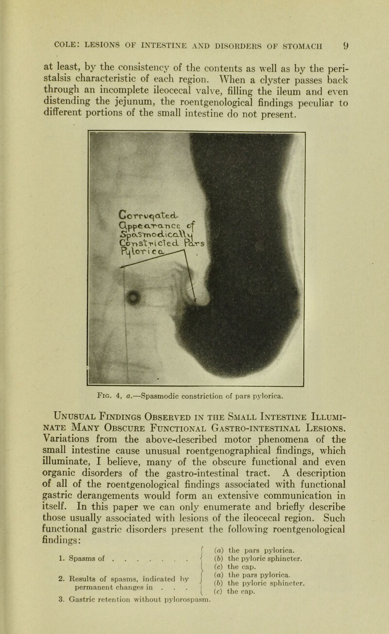 at least, by the consistency of the contents as well as by the peri- stalsis characteristic of each region. When a clyster passes back through an incomplete ileocecal valve, filling the ileum and even distending the jejunum, the roentgenological findings peculiar to different portions of the small intestine do not present. Fig. 4, a.—Spasmodic constriction of pars pylorica. Unusual Findings Observed in the Small Intestine Illumi- nate Many Obscure Functional Gastro-intestinal Lesions. Variations from the above-described motor phenomena of the small intestine cause unusual roentgenographical findings, which illuminate, I believe, many of the obscure functional and even organic disorders of the gastro-intestinal tract. A description of all of the roentgenological findings associated with functional gastric derangements would form an extensive communication in itself. In this paper we can only enumerate and briefly describe those usually associated with lesions of the ileocecal region. Such functional gastric disorders present the following roentgenological findings: 1. Spasms of j 2. Results of spasms, indicated by permanent changes in . 3. Gastric retention without pylorospasm. (a) the pars pylorica. (£>) the pyloric sphincter, (c) the cap. (a) the pars pylorica. (b) the pyloric sphincter. (c) the cap.