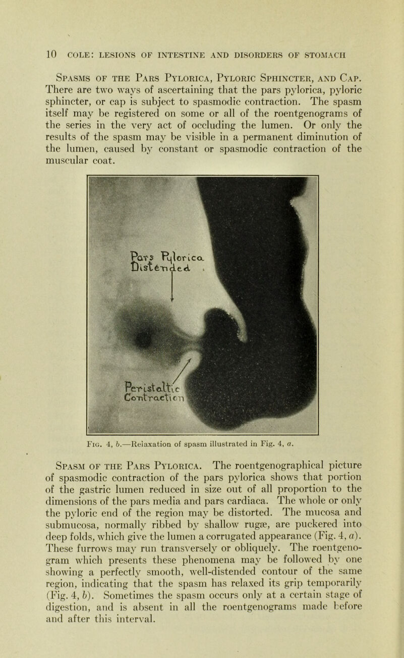 Spasms of the Pars Pylorica, Pyloric Sphincter, and Cap. There are two ways of ascertaining that the pars pylorica, pyloric sphincter, or cap is subject to spasmodic contraction. The spasm itself may be registered on some or all of the roentgenograms of the series in the very act of occluding the lumen. Or only the results of the spasm may be visible in a permanent diminution of the lumen, caused by constant or spasmodic contraction of the muscular coat. Fig. 4, b.—Relaxation of spasm illustrated in Fig. 4, a. Spasm of the Pars Pylorica. The roentgenographical picture of spasmodic contraction of the pars pylorica shows that portion of the gastric lumen reduced in size out of all proportion to the dimensions of the pars media and pars cardiaca. The whole or only the pyloric end of the region may be distorted. The mucosa and submucosa, normally ribbed by shallow rugte, are puckered into deep folds, which give the lumen a corrugated appearance (Fig. 4, a). These furrows may run transversely or obliquely. The roentgeno- gram which presents these phenomena may be followed by one showing a perfectly smooth, well-distended contour of the same region, indicating that the spasm has relaxed its grip temporarily (Fig. 4, b). Sometimes the spasm occurs only at. a certain stage of digestion, and is absent in all the roentgenograms made before and after this interval.