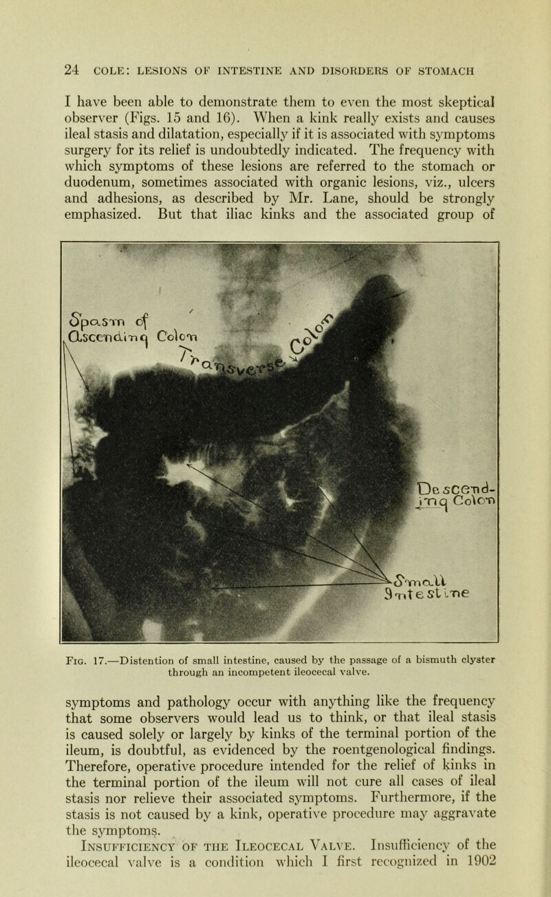 I have been able to demonstrate them to even the most skeptical observer (Figs. 15 and 16). When a kink really exists and causes ileal stasis and dilatation, especially if it is associated with symptoms surgery for its relief is undoubtedly indicated. The frequency with which symptoms of these lesions are referred to the stomach or duodenum, sometimes associated with organic lesions, viz., ulcers and adhesions, as described by Mr. Lane, should be strongly emphasized. But that iliac kinks and the associated group of DcsCend- j/ncj Colot> Spa, sun of C\ .'irp'n ri i Tn ri Col ( On SyticlLI 3 Tit e st ine Fig. 17.—Distention of small intestine, caused by the passage of a bismuth clyster through an incompetent ileocecal valve. symptoms and pathology occur with anything like the frequency that some observers would lead us to think, or that ileal stasis is caused solely or largely by kinks of the terminal portion of the ileum, is doubtful, as evidenced by the roentgenological findings. Therefore, operative procedure intended for the relief of kinks in the terminal portion of the ileum will not cure all cases of ileal stasis nor relieve their associated symptoms. Furthermore, if the stasis is not caused by a kink, operative procedure may aggravate the symptoms. Insufficiency of the Ileocecal Valve. Insufficiency of the ileocecal valve is a condition which I first recognized in 1902