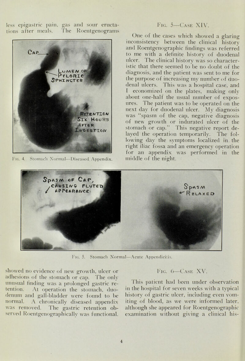 tions after meals. The Roentgenograms Fig. 4. Stomach Normal—Diseased Appendix. ()ne of the cases which showed a glaring inconsistency between the clinical history and Roentgenographic findings was referred to me with a definite history of duodenal ulcer. \ he clinical history was so character- istic that there seemed to he no doubt of the diagnosis, and the patient was sent to me for the purpose of increasing my number of duo- denal ulcers. This was a hospital case, and I economized on the plates, making only about one-half the usual number of expos- ures. Idie patient was to be operated on the next day for duodenal ulcer. My diagnosis was “spasm of the cap, negative diagnosis of new growth or indurated ulcer of the stomach or cap. This negative report de- layed the operation temporarily. The fol- lowing day the symptoms localized in the right iliac fossa and an emergency operation for an appendix was performed in the middle of the night. asm of Cap, CAUSIA/G FLUTet* APP6AR AA/CE Fig. 5. Stomach Normal—Acute Appendicitis. showed no evidence of new growth, ulcer or adhesions of the stomach or cap. The only unusual finding was a prolonged gastric re- tention. At operation the stomach, duo- denum and gall-bladder were found to be normal. A chronically diseased appendix was removed. The gastric retention ob- served Roentgenographically was functional. Fig. 6—Case XV. This patient had been under observation in the hospital for seven weeks with a typical history of gastric ulcer, including even vom- iting of blood, as we were informed later, although she appeared for Roentgenographic examination without giving a clinical his-