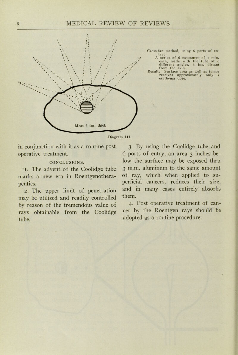 Cross-fire method, using 6 ports of en- try: A series of 6 exposures of i min, each, made with the tube at 6 different angles, 6 ins. distant from the skin. Result: Surface area as well as tumor receives approximately only i erethyma dose. in conjunction with it as a routine post operative treatment. CONCLUSIONS. •i. The advent of the Coolidge tube marks a new era in Roentgenothera- peutics. 2. The upper limit of penetration may be utilized and readily controlled by reason of the tremendous value of rays obtainable from the Coolidge tube. 3. By using the Coolidge tube and 6 ports of entry, an area 3 inches be- low the surface may be exposed thru 3 m.m. aluminum to the same amount of ray, which when applied to su- perficial cancers, reduces their size, and in many cases entirely absorbs them. 4. Post operative treatment of can- cer by the Roentgen rays should be adopted as a routine procedure.