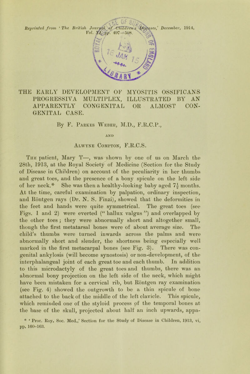 PROGRESSIVA MULTIPLEX, ILLUSTRATED BY AN APPARENTLY CONGENITAL OR ALMOST CON- GENITAL CASE. By F. Parkes Weber, M.D., F.R.C.P., AND Alwyne Compton, F.R.C.S. The patient, Mary T—, was shown by one of us on March the 28tli, 1913, at the Royal Society of Medicine (Section for the Study of Disease in Children) on account of the peculiarity in her thumbs and great toes, and the presence of a bony spicule on the left side of her neck.* She was then a liealthy-looking baby aged 7-| months. At the time, careful examination by palpation, ordinary inspection, and Rontgen rays (Dr. N. S. Finzi), showed that the deformities in the feet and hands were cjuite symmetrical. The great toes (see Figs. 1 and 2) were everted (“ hallux valgus ”) and overlapped by the other toes ; they were abnormally short and altogether small, though the first metatarsal bones were of about average size. The child’s thumbs were turned inwards across the palms and were abnormally short and slender, the shortness being especially well marked in the first metacarpal bones (see Fig. 3). There was con- genital ankylosis (will become synostosis) or non-development, of the interphalangeal joint of each great toe and each thumb. In addition to this microdactyly of the great toes and thumbs, there was an abnormal bony projection on the left side of the neck, which might have been mistaken for a cervical rib, but Rontgen ray examination (see Fig. 4) showed the outgrowth to be a thin spicule of bone attached to the back of the middle of the left clavicle. This spicule, which reminded one of the styloid process of the temporal bones at the base of the skull, projected about half an inch upwards, appa- * ' Proc. Roy. Soc. Med.,5 Section for the Study of Disease in Children, 1913, vi, pp. 160-163.