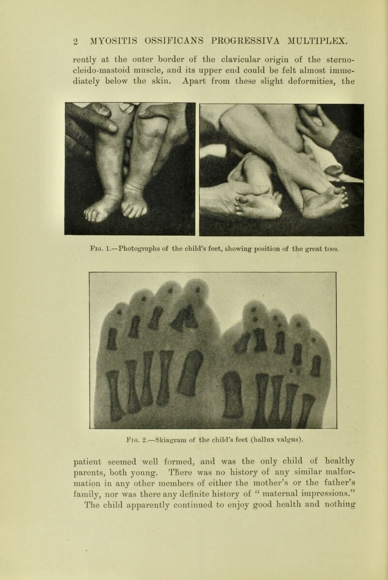 rently at the outer border of the clavicular origin of the sterno- cleido-mastoid muscle, and its upper end could be felt almost imme- diately below the skin. Apart from these slight deformities, the Fig. 1.—Photographs of the child’s feet, showing position of the great toes. Fig. 2.—Skiagram of the child’s feet (hallux valgus). patient seemed well formed, and was the only child of healthy parents, both young. There was no history of any similar malfor- mation in any other members of either the mother’s or the father’s family, nor was there any definite history of “ maternal impressions.” The child apparently continued to enjoy good health and nothing