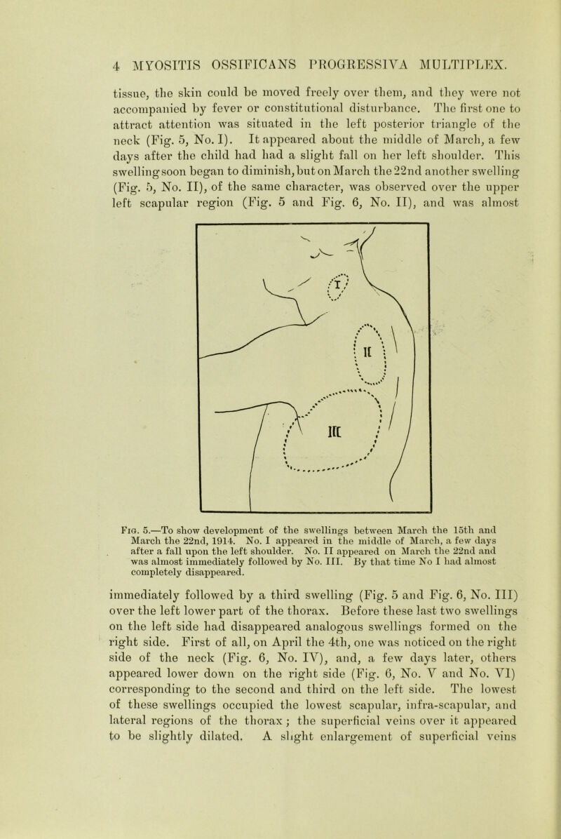 tissue, the skin could be moved freely over them, and they were not accompanied by fever or constitutional disturbance. The first one to attract attention was situated in the left posterior triangle of the neck (Fig. 5, No. I). It appeared about the middle of March, a few days after the child had had a slight fall on her left shoulder. This swellingsoon began to diminish,but on March the 22nd another swelling (Fig. 5, No. II), of the same character, was observed over the upper left scapular region (Fig. 5 and Fig. 6, No. II), and was almost Fig. 5.—To show development of the swellings between March the 15th and March the 22nd, 1914. No. I appeared in the middle of March, a few days after a fall upon the left shoulder. No. II appeared on March the 22nd and was almost immediately followed by No. III. By that time No I had almost completely disappeared. immediately followed by a third swelling (Fig. 5 and Fig. 6, No. Ill) over the left lower part of the thorax. Before these last two swellings on the left side had disappeared analogous swellings formed on the right side. First of all, on April the 4th, one was noticed on the right side of the neck (Fig. 6, No. IV), and, a few days later, others appeared lower down on the right side (Fig. 6, No. V and No. VI) corresponding to the second and third on the left side. The lowest of these swellings occupied the lowest scapular, infra-scapular, and lateral regions of the thorax ; the superficial veins over it appeared to be slightly dilated. A slight enlargement of superficial veins