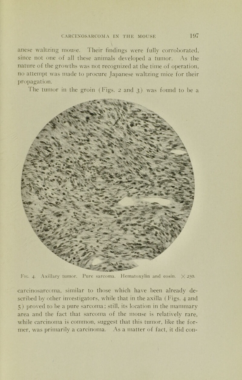 anese waltzing mouse. rl heir findings were fully corroborated, since not one of all these animals developed a tumor. As the nature of the growths was not recognized at the time of operation, no attempt was made to procure Japanese waltzing mice for their propagation. 1 he tumor in the groin (Figs. 2 and 3) was found to be a , £ V*' * Xa V** ^ VU<■• -w Sa*Skv « * Itor e C* -v -.a’* -1 - m *?*1 w-. ?^*Vv 1 , ~ ? 'JSr - € -.a ■ 2ft ' - ,'***»■* fciiis* -iSafe. «4S^V«J&,V '»g ' v * - if . - 4 »-;/ - MA k Fig. 4. Axillary tumor. Pure sarcoma. Hematoxylin and eosin. X 250. carcinosarcoma, similar to those which have been already de- scribed by other investigators, while that in the axilla (Figs. 4 and 5) proved to he a pure sarcoma; still, its location in the mammary area and the fact that sarcoma of the mouse is relatively rare, while carcinoma is common, suggest that this tumor, like the for- mer, was primarily a carcinoma. As a matter of fact, it did con-