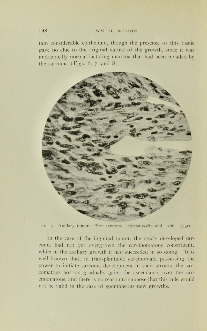 tain considerable epithelium, though the presence of this tissue gave no clue to the original nature of the growth, since it was undoubtedly normal lactating mamma that had been invaded by the sarcoma (Figs. 6, 7, and 8). Fig. 5. Axillary tumor. Pure sarcoma. Hematoxylin and eosin. X 5°°- In the case of the inguinal tumor, the newly developed sar- coma had not yet overgrown the carcinomatous constituent, while in the axillarv growth it had succeeded in so doing. It is well known that, in transplantable carcinomata possessing the power to initiate sarcoma development in their stroma, the sar- comatous portion gradually gains the ascendancy over the car- cinomatous, and there is no reason to suppose that this rule would not he valid in the case of spontaneous new growths.