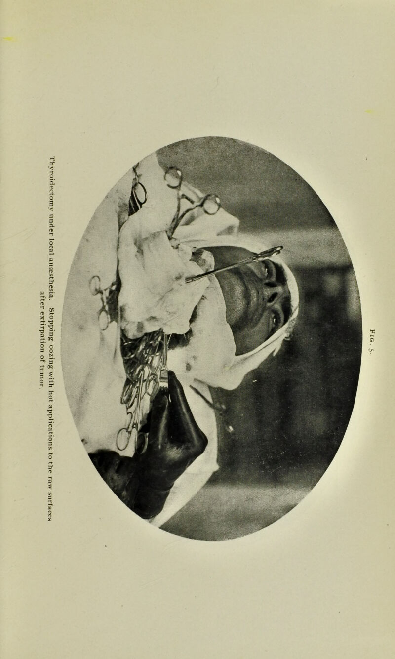 Thyroidectomy under local anaesthesia. Stopping oozing with hot applications to the raw surfaces after extirpation of tnmor. sap**5