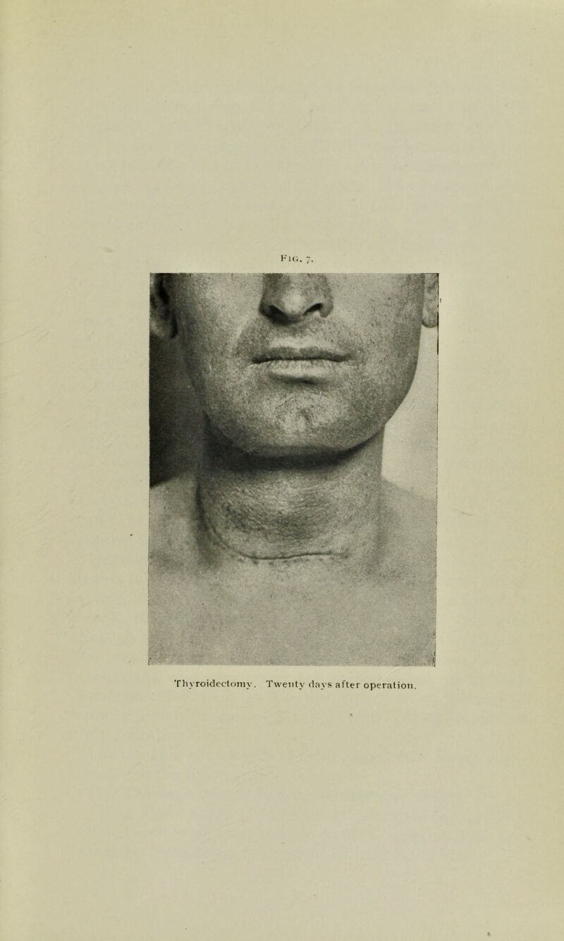 Thyroidectomy. Twenty days alter operation.