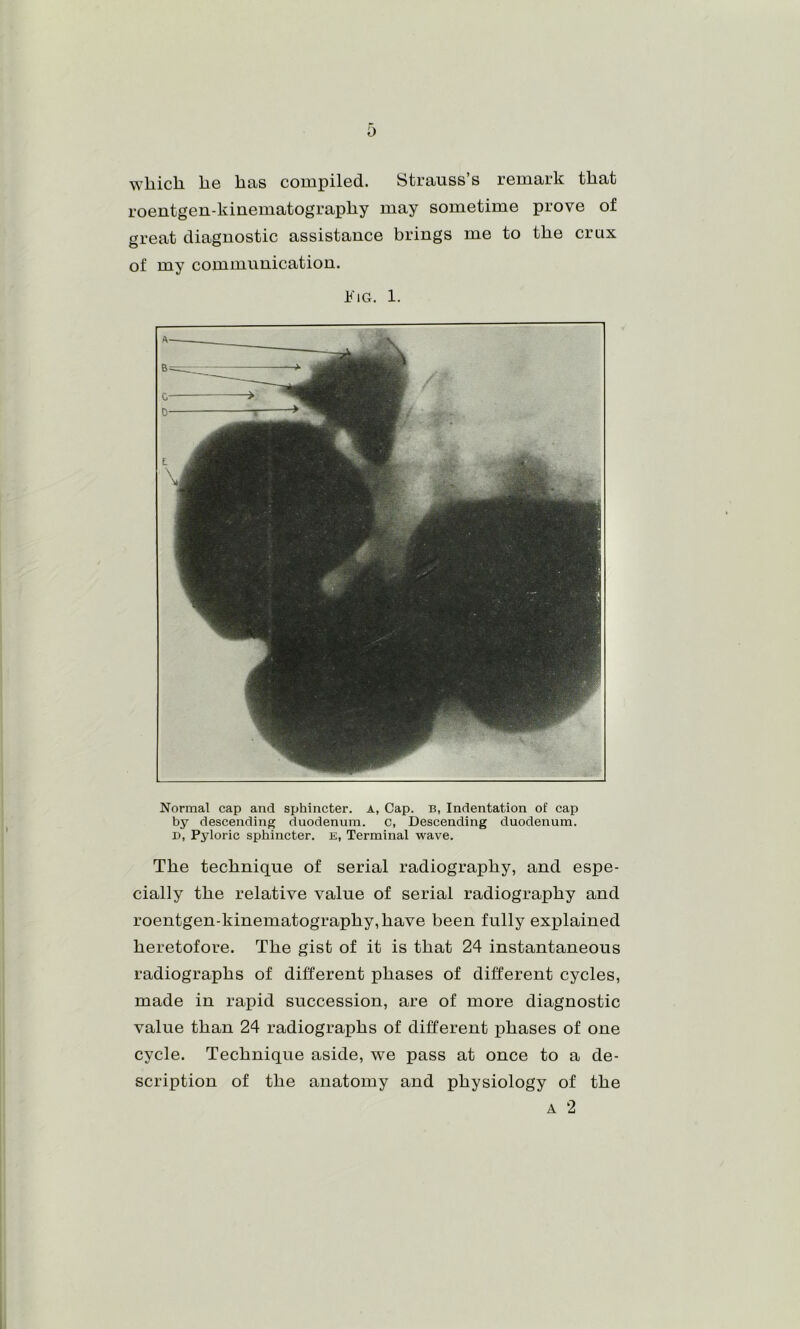 which he has compiled. Strauss’s remark that roentgen-kiuematography may sometime prove of sreat diagnostic assistance brings me to the crux of my communication. ¥\G. 1. Normal cap and sphincter. A, Cap. B, Indentation of cap by descending duodenum, c, Descending duodenum. D, Pyloric sphincter, e, Terminal wave. The technique of serial radiography, and espe- cially the relative value of serial radiography and roentgen-kinematography,have been fully exx3lained heretofore. The gist of it is that 24 instantaneous radiographs of different phases of different cycles, made in rapid succession, are of more diagnostic value than 24 radiographs of different phases of one cycle. Technique aside, we pass at once to a de- scription of the anatomy and physiology of the A 2