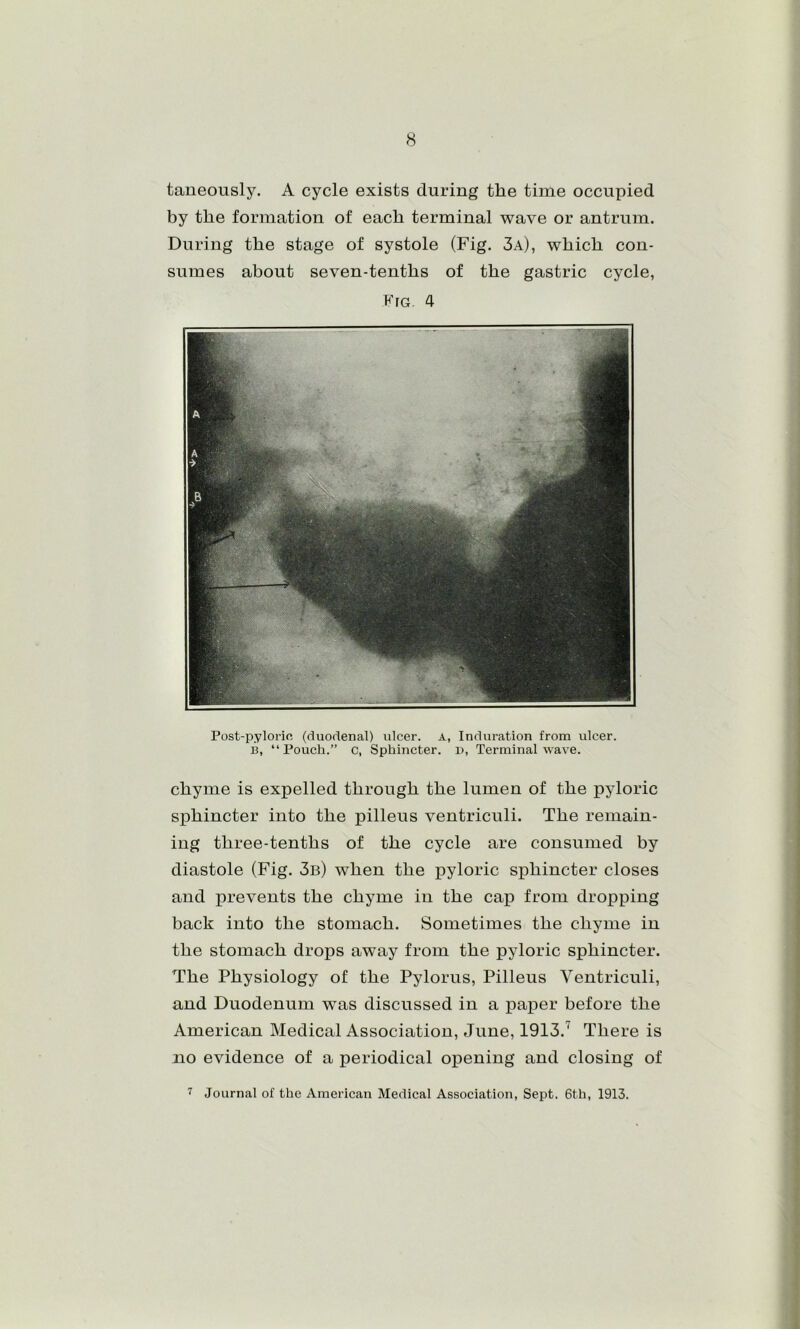 taneously. A cycle exists during the time occupied by the formation of each terminal wave or antrum. During the stage of systole (Fig. 3a), which con- sumes about seven-tenths of the gastric cycle, Fro. 4 Post-pylorin (duodenal) ulcer, a, Induration from ulcer. B, “ Pouch.” c, Sphincter, n, Terminal wave. chyme is expelled through the lumen of the pyloric sphincter into the pilleus ventriculi. The remain- ing three-tenths of the cycle are consumed by diastole (Fig. 3b) when the pyloric sphincter closes and prevents the chyme in the cap from dropping back into the stomach. Sometimes the chyme in the stomach drops away from the pyloric sphincter. The Physiology of the Pylorus, Pilleus Ventriculi, and Duodenum was discussed in a pajier before the American Medical Association, June, 1913.^ There is no evidence of a periodical opening and closing of 7 Journal of the American Medical Association, Sept. 6th, 1913.