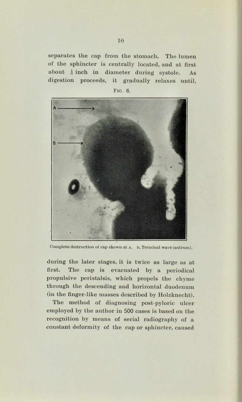 sei^arates the cap from the stomach. The lumen of the sphincter is centrally located, and at first about ^ inch in diameter during systole. As digestion proceeds, it gradually relaxes until. Fig. 6. Complete destruction of cap shown at a. b, Terminal wave (antrum). during the later stages, it is twice as large as at first. The cap is evacuated by a periodical propulsive peristalsis, which propels the chyme through the descending and horizontal duodenum (in the finger-like masses described by Holzknecht). The method of diagnosing post-pyloric ulcer employed by the author in 500 cases is based on the recognition by means of serial radiography of a constant deformity of the cap or sphincter, caused