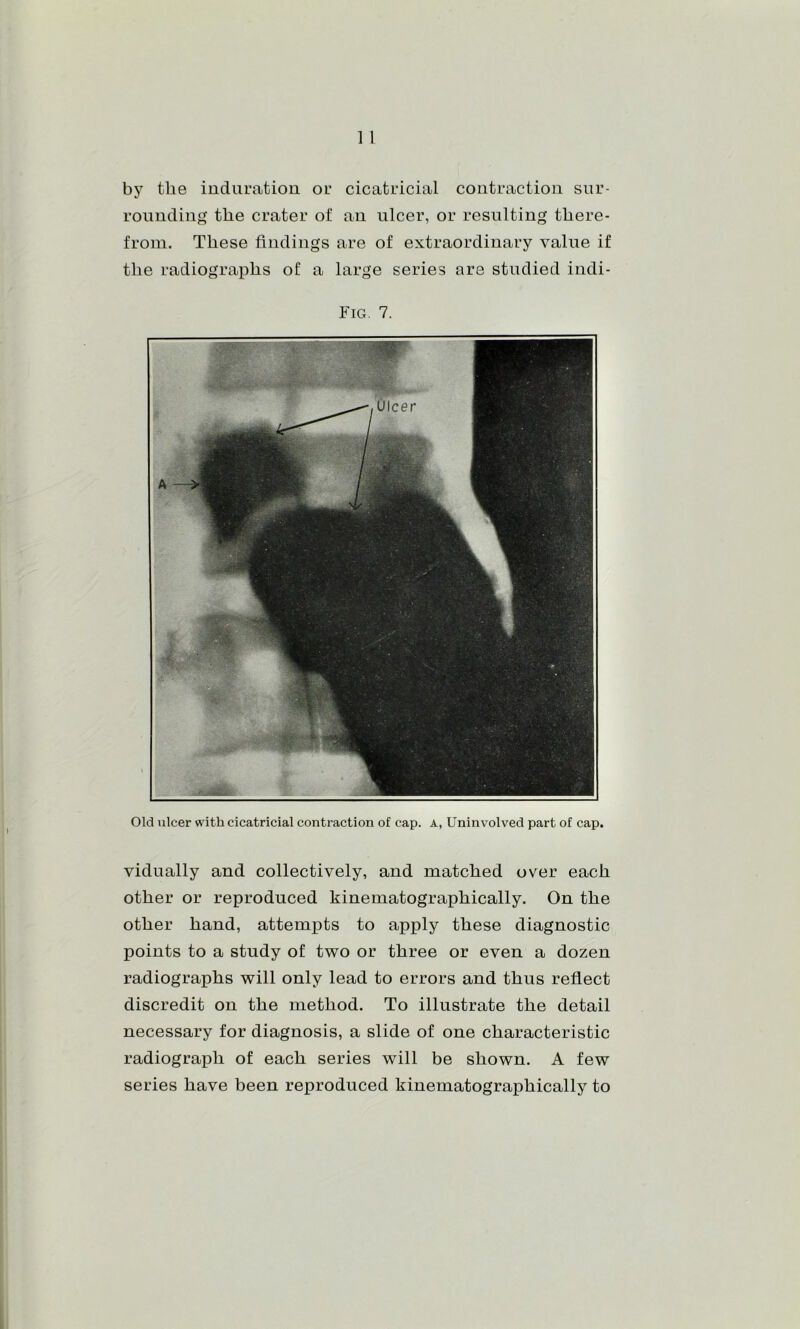 by the induration or cicatricial contraction sur- rounding the crater of an ulcer, or resulting there- from. These findings are of extraordinary value if the radiographs of a large series are studied indi- Fig. 7. Old ulcer with cicatricial contraction of cap. a, Uninvolved part of cap. vidually and collectively, and matched over each other or reproduced kinematographically. On the other hand, attempts to apply these diagnostic points to a study of two or three or even a dozen radiographs will only lead to errors and thus reflect discredit on the method. To illustrate the detail necessary for diagnosis, a slide of one characteristic radiograph of each series will be shown. A few series have been reproduced kinematographically to