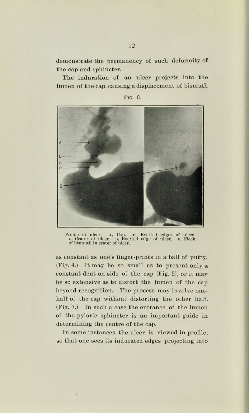 demonstrate the permanency of such deformity of the cap and sphincter. The induration of an ulcer projects into the lumen of the cap, causing a displacement of bismuth Fig. 8. Profile of ulcer. a. Cap. b. Everted edges of ulcer, c, Crater of ulcer. D, Everted edge of ulcer. E, Fleck of bismuth in crater of ulcer. as constant as one’s finger-prints in a ball of putty. (Fig. 4.) It may be so small as to present only a constant dent on side of the cap (Fig. 5), or it may be so extensive as to distort the lumen of the cap beyond recognition. The process may involve one- half of the cap without distorting the other half. (Fig. 7.) In such a case the entrance of the lumen of the pyloric sphincter is an important guide in determining the centre of the cap. In some instances the ulcer is viewed in profile, so that one sees its indurated edges projecting into