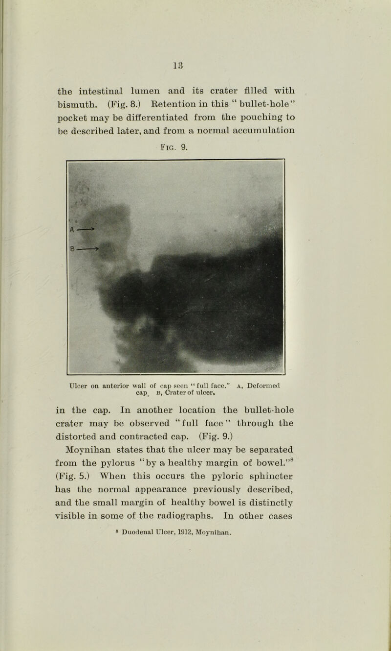 the intestinal Ininen and its crater filled with bismuth. (Fig. 8.) Retention in this “ bullet-hole” pocket may be differentiated from the pouching to be described later, and from a normal accumulation Fig. 9. Ulcer on anterior wall of cap seen “ full face.” a, Deformed cap B, Crater of ulcer. in the cap. In another location the bullet-hole crater may be observed “full face” through the distorted and contracted cap. (Fig. 9.) Moynihan states that the ulcer may be separated from the pylorus “by a healthy margin of bowel.”® (Fig. 5.) When this occurs the pyloric sphincter has the normal appearance previously described, and the small margin of healthy bowel is distinctly visible in some of the radiographs. In other cases » Duodenal Ulcer, 1912, Moynihan.