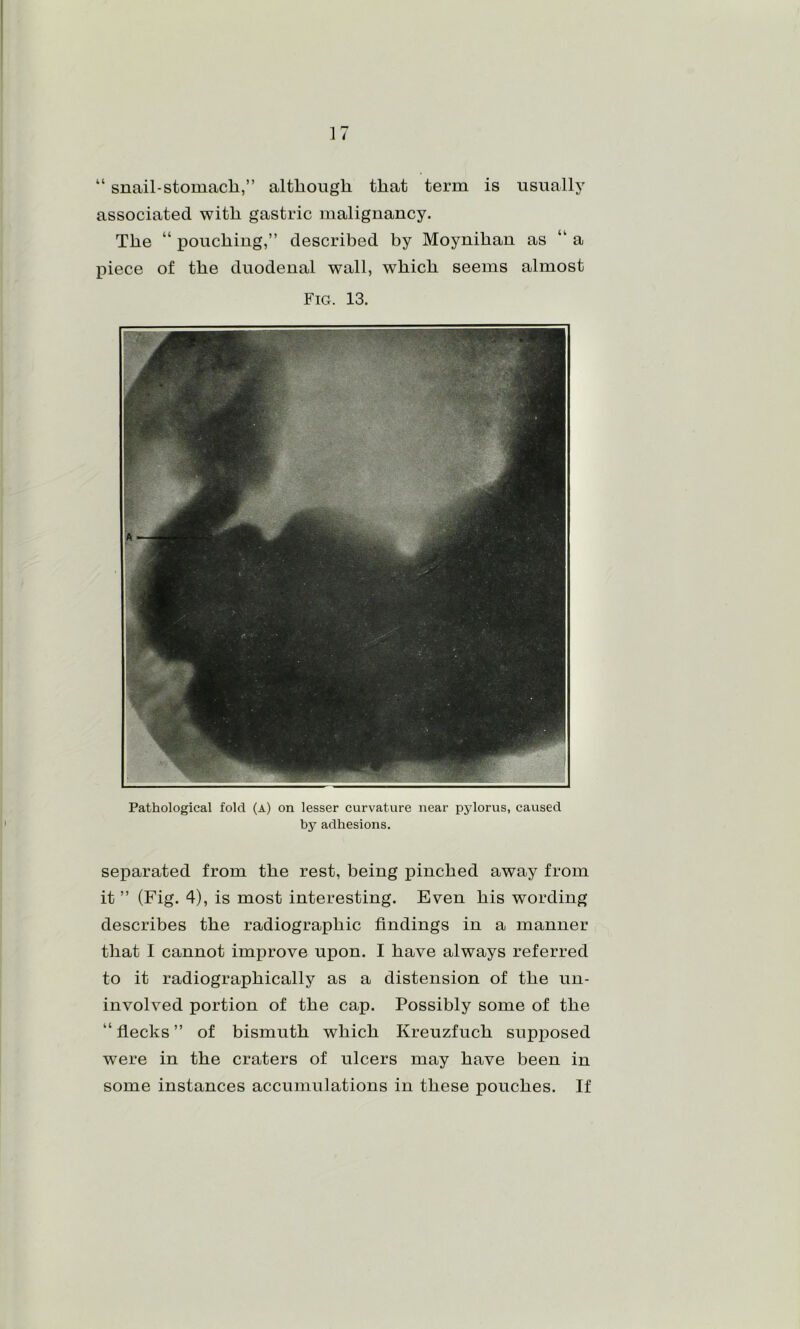 [ 17 “ snail-stomach,” although that term is usually associated with gastric malignancy. The “ pouching,” described by Moynihan as “ a piece of the duodenal wall, which seems almost Fig. 13. Pathological fold (a) on lesser curvature near pylorus, caused by adhesions. separated from the rest, being pinched away from it ” (Fig. 4), is most interesting. Even his wording describes the radiographic findings in a manner that I cannot improve upon. I have always referred to it radiographically as a distension of the un- involved portion of the cap. Possibly some of the “ fiecks ” of bismuth which Kreuzfuch supposed were in the craters of ulcers may have been in some instances accumulations in these pouches. If