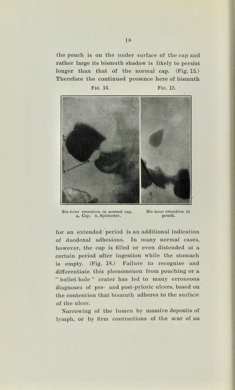 the pouch is on the under surface of the cap and rather large its bismuth shadow is likely to persist longer than that of the normal cap. (Fig, 15.) Therefore the continued presence here of bismuth Fig. 14. Fig. 15. Six-hour retention in normal cap. Six-hour retention in A, Cap. B, Sphincter. pouch. for an extended ^ period is an additional indication of duodenal adhesions. In many normal cases, however, the cap is filled or even distended at a certain period after ingestion while the stomach is empty. (Fig. 14.) Failure to recognise and differentiate this phenomenon from pouching or a “ bullet-hole ” crater has led to many erroneous diagnoses of pre- and post-pyloric ulcers, based on the contention that bismuth adheres to the surface of the ulcer. Narrowing of the lumen by massive deposits of lymph, or by firm contractions of the scar of an