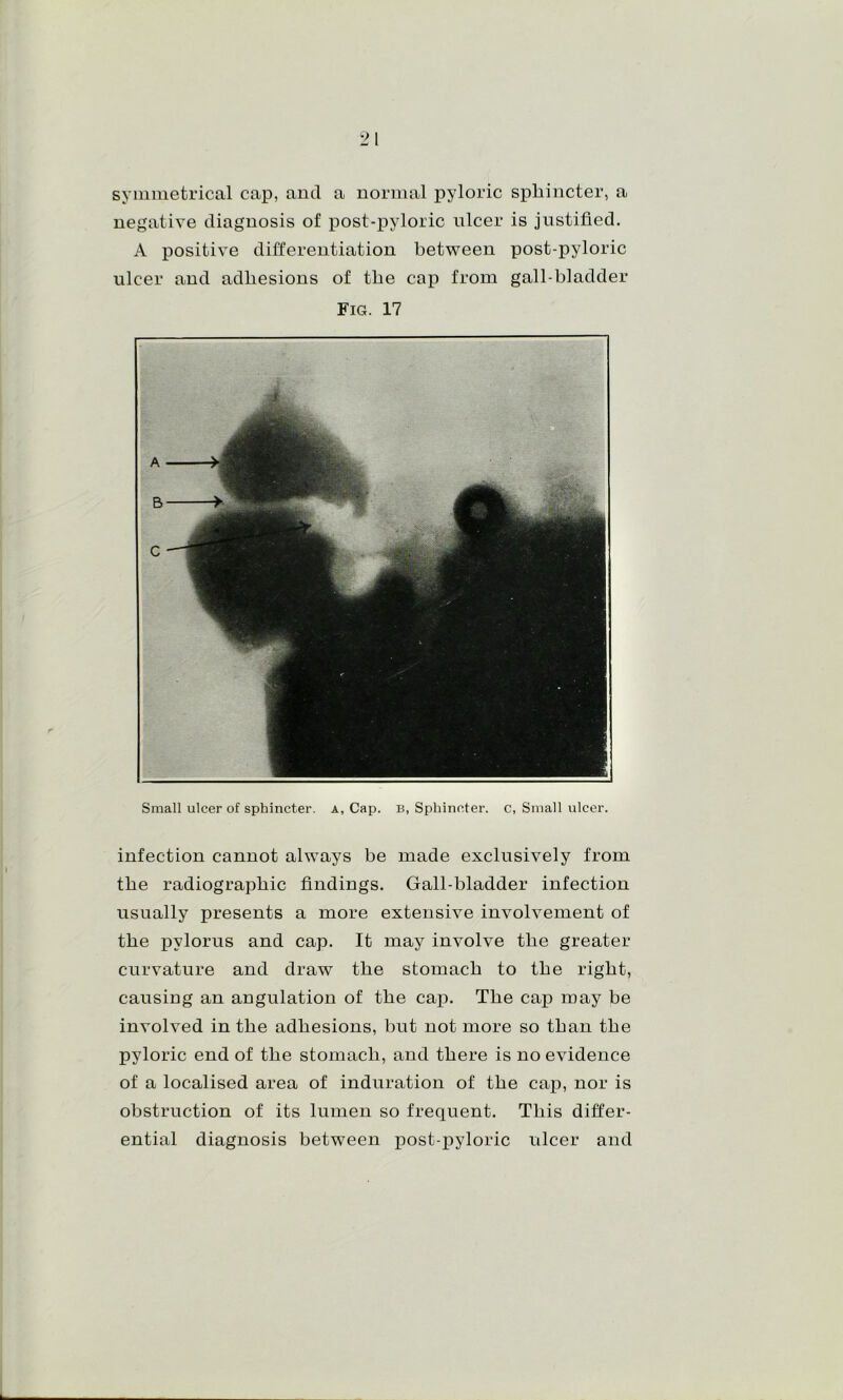 syinmetrical cap, and a normal pyloric sphincter, a negative diagnosis of post-pyloric nicer is justified. A positive differentiation between post-pyloric ulcer and adhesions of the cap from gall-bladder Fig. 17 Small ulcer of sphincter. A, Cap. B, Sphincter, c, Small ulcer. infection cannot always be made exclusively from the radiographic findings. Gall-bladder infection usually presents a more extensive involvement of the pylorus and cap. It may involve the greater curvature and draw the stomach to the right, causing an angulation of the cap. The cap may be involved in the adhesions, but not more so than the pyloric end of the stomach, and there is no evidence of a localised area of induration of the cap, nor is obstruction of its lumen so frequent. This differ- ential diagnosis between post-j)yloric ulcer and