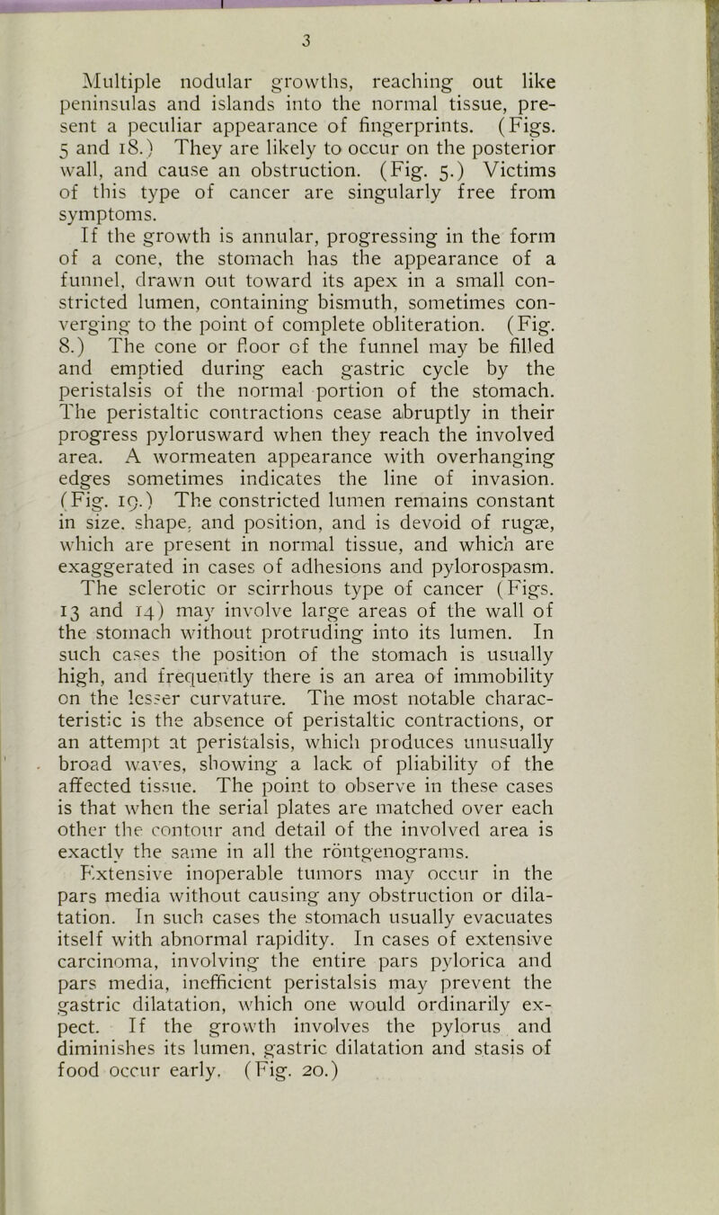 Multiple nodular growths, reaching out like peninsulas and islands into the normal tissue, pre- sent a peculiar appearance of fingerprints. (Figs. 5 and 18.) They are likely to occur on the posterior wall, and cause an obstruction. (Fig. 5.) Victims of this type of cancer are singularly free from symptoms. If the growth is annular, progressing in the form of a cone, the stomach has the appearance of a funnel, drawn out toward its apex in a small con- stricted lumen, containing bismuth, sometimes con- verging to the point of complete obliteration. (Fig. 8.) The cone or floor of the funnel may be filled and emptied during each gastric cycle by the peristalsis of the normal portion of the stomach. The peristaltic contractions cease abruptly in their progress pylorusward when they reach the involved area. A wormeaten appearance with overhanging edges sometimes indicates the line of invasion. (Fig. 19.) The constricted lumen remains constant in size, shape, and position, and is devoid of rugse, which are present in normal tissue, and which are exaggerated in cases of adhesions and pylorospasm. The sclerotic or scirrhous type of cancer (Figs. 13 and 14) may involve large areas of the wall of the stomach without protruding into its lumen. In such cases the position of the stomach is usually high, and frequently there is an area of immobility on the lesser curvature. The most notable charac- teristic is the absence of peristaltic contractions, or an attempt at peristalsis, which produces unusually broad waves, showing a lack of pliability of the affected tissue. The point to observe in these cases is that when the serial plates are matched over each other the contour and detail of the involved area is exactly the same in all the rontgenograms. F.xtensive inoperable tumors may occur in the pars media without causing any obstruction or dila- tation. In such cases the stomach usually evacuates itself with abnormal rapidity. In cases of extensive carcinoma, involving the entire pars pylorica and pars media, inefficient peristalsis may prevent the gastric dilatation, which one would ordinarily ex- pect. If the growth involves the pylorus and diminishes its lumen, gastric dilatation and stasis of food occur early. (Fig. 20.)